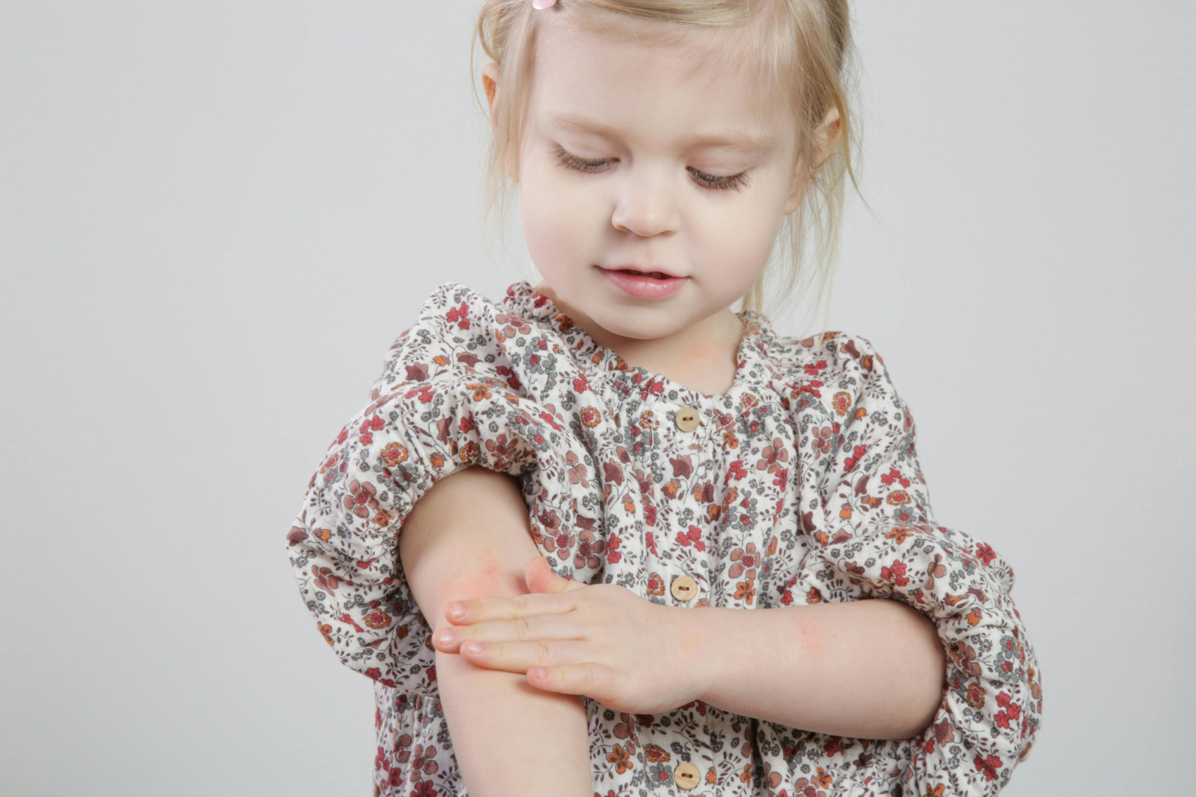 dermatitis niños