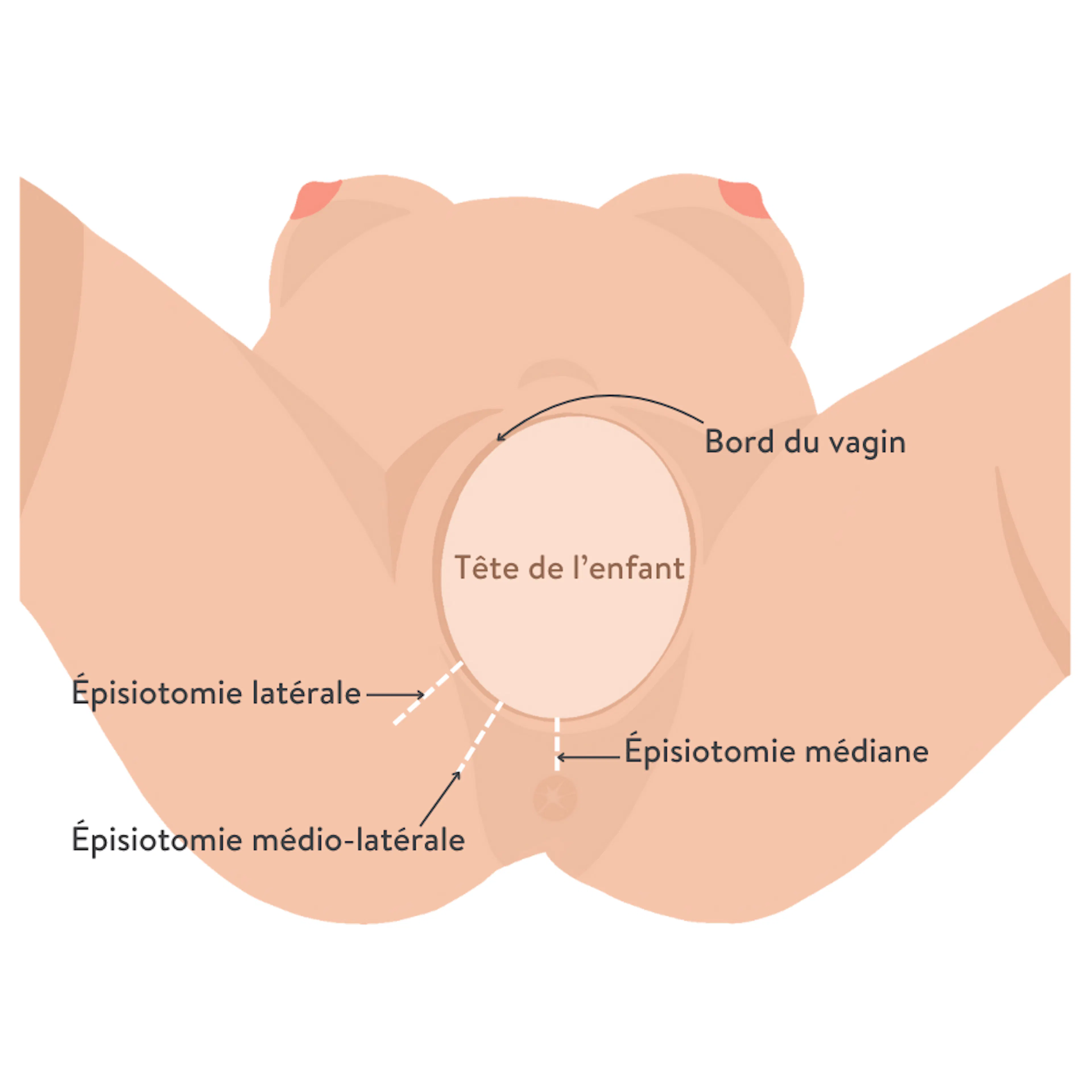 épisiotomie boiron