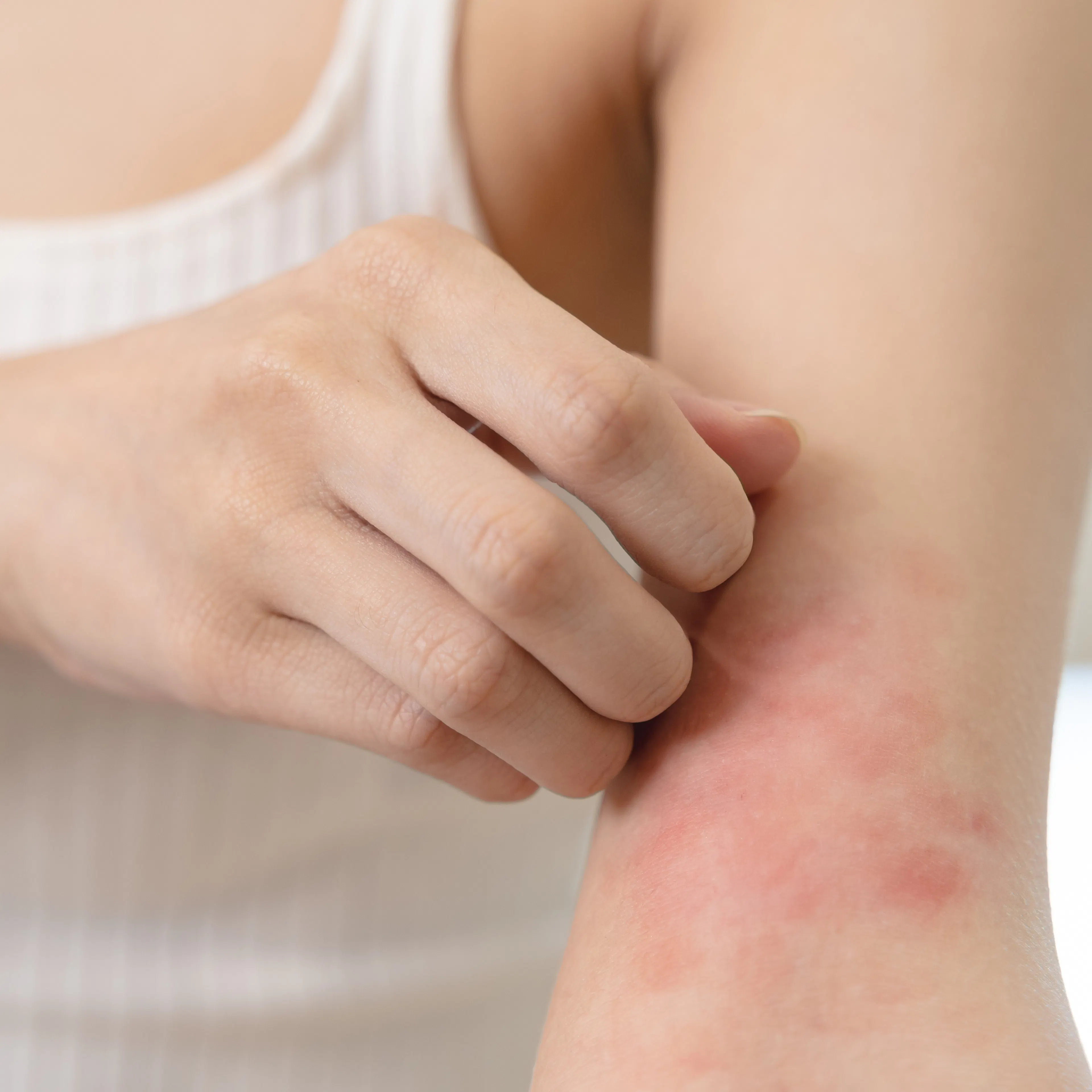 symptômes cutanés allergie Boiron