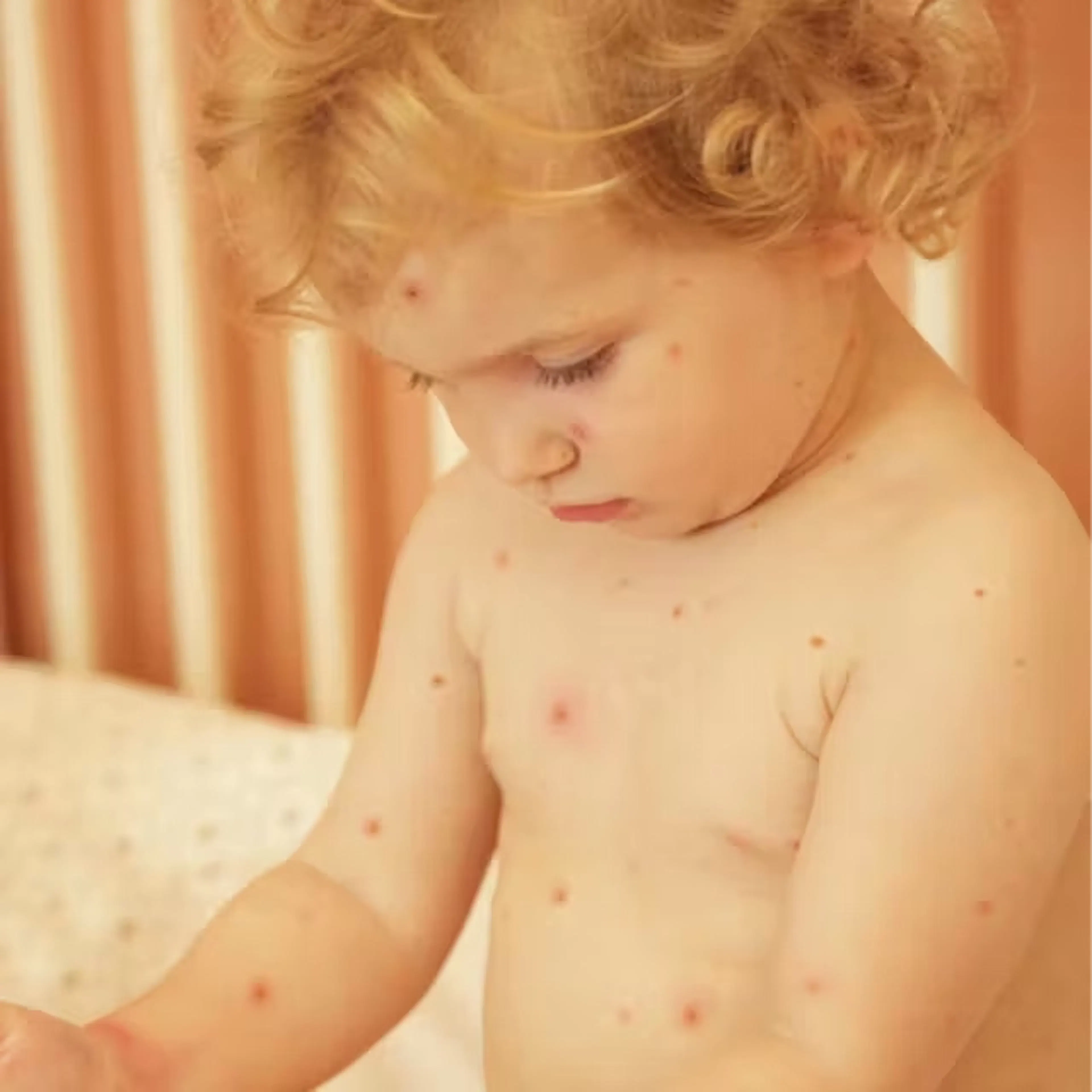 waterpokken lichaam kind infectieziekte bij kinderen