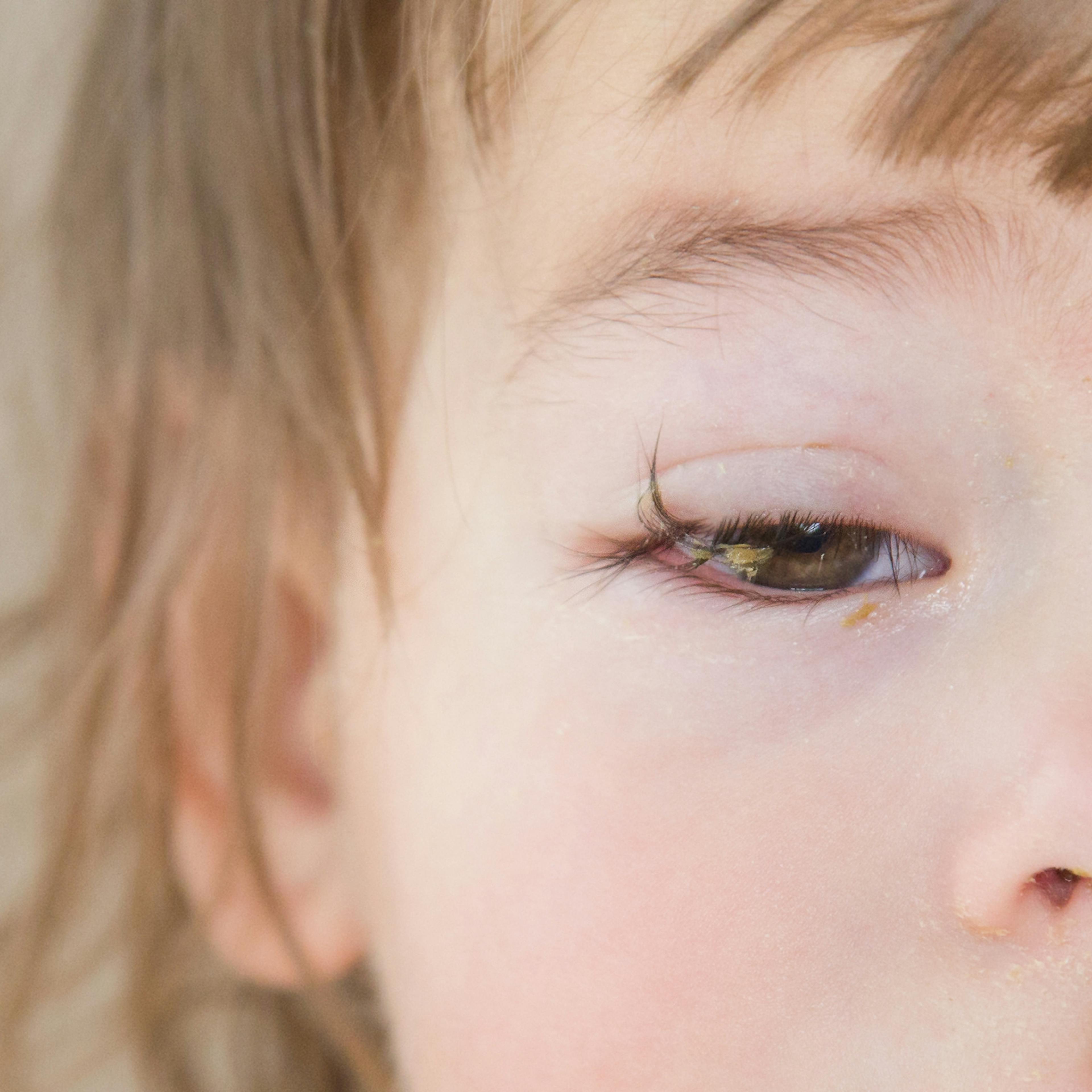 L'homéopathie pour soulager la conjonctivite