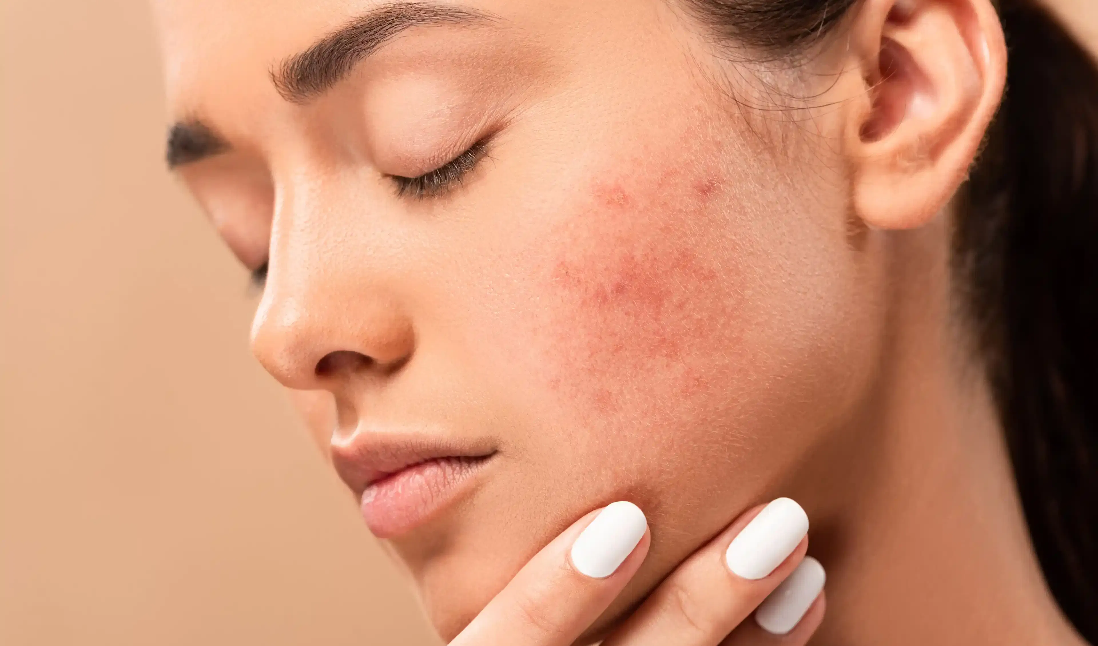 Visage de femme avec irritations cutanées
