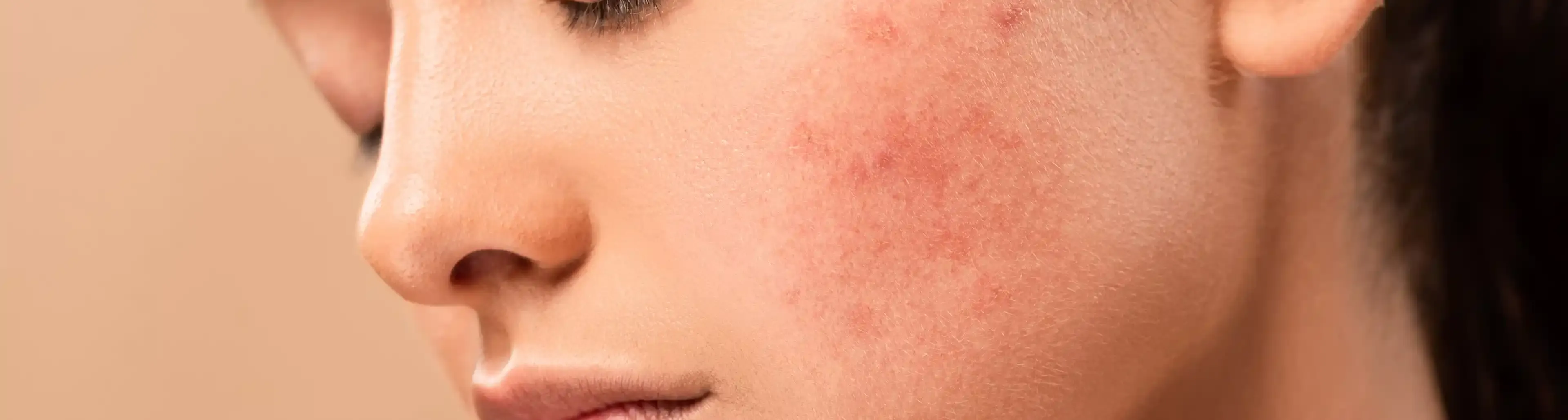 Visage de femme avec irritations cutanées