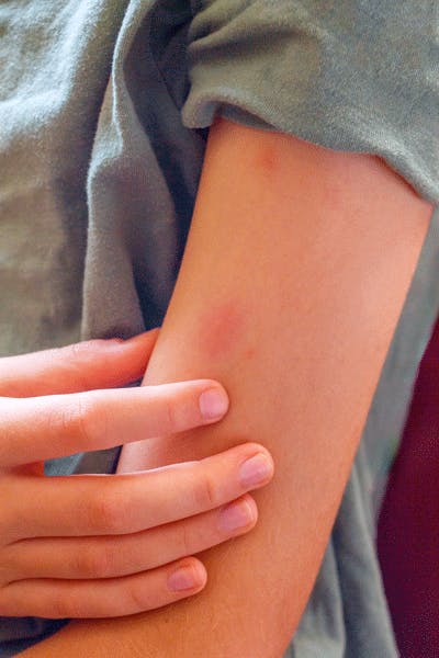 Girl with red spot on her arm