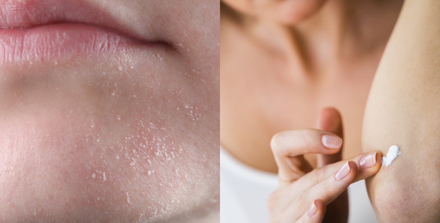 Dry skin on elbow and face