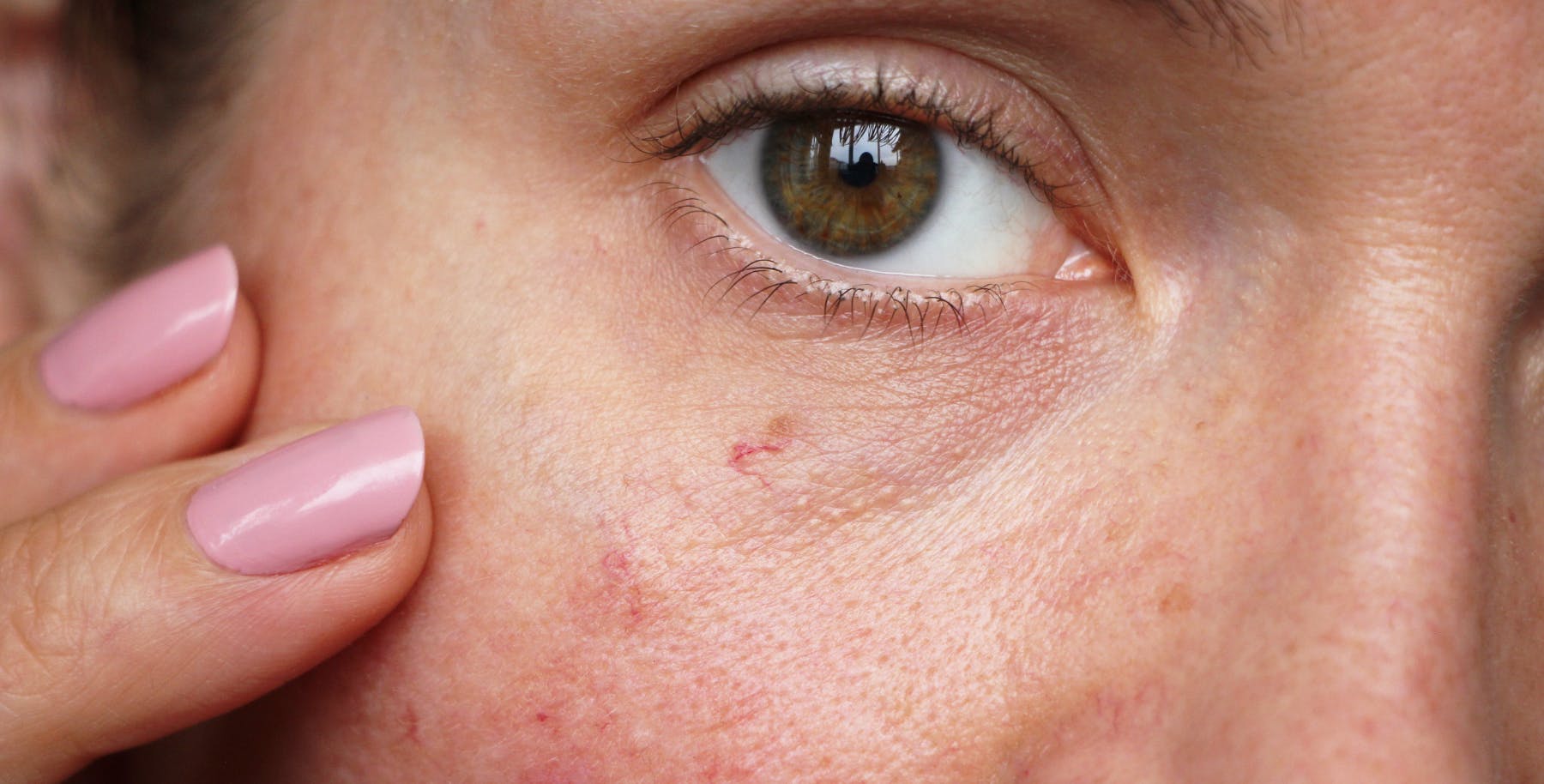 Sensitive skin flare-up during winter