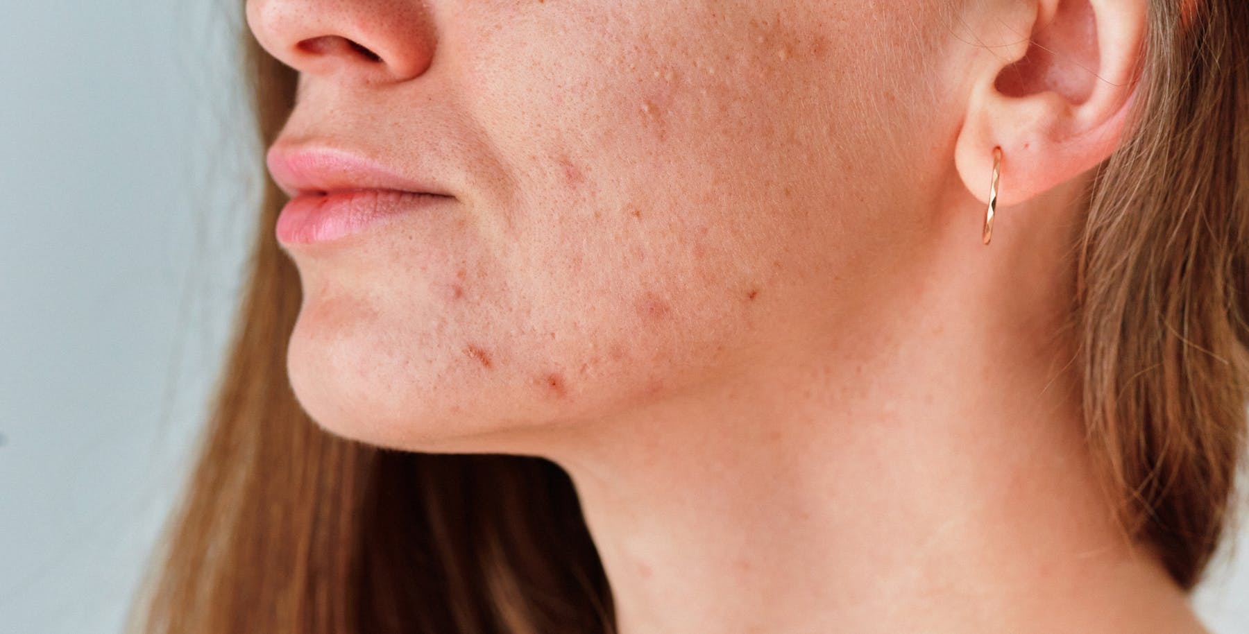 Women with acne skin