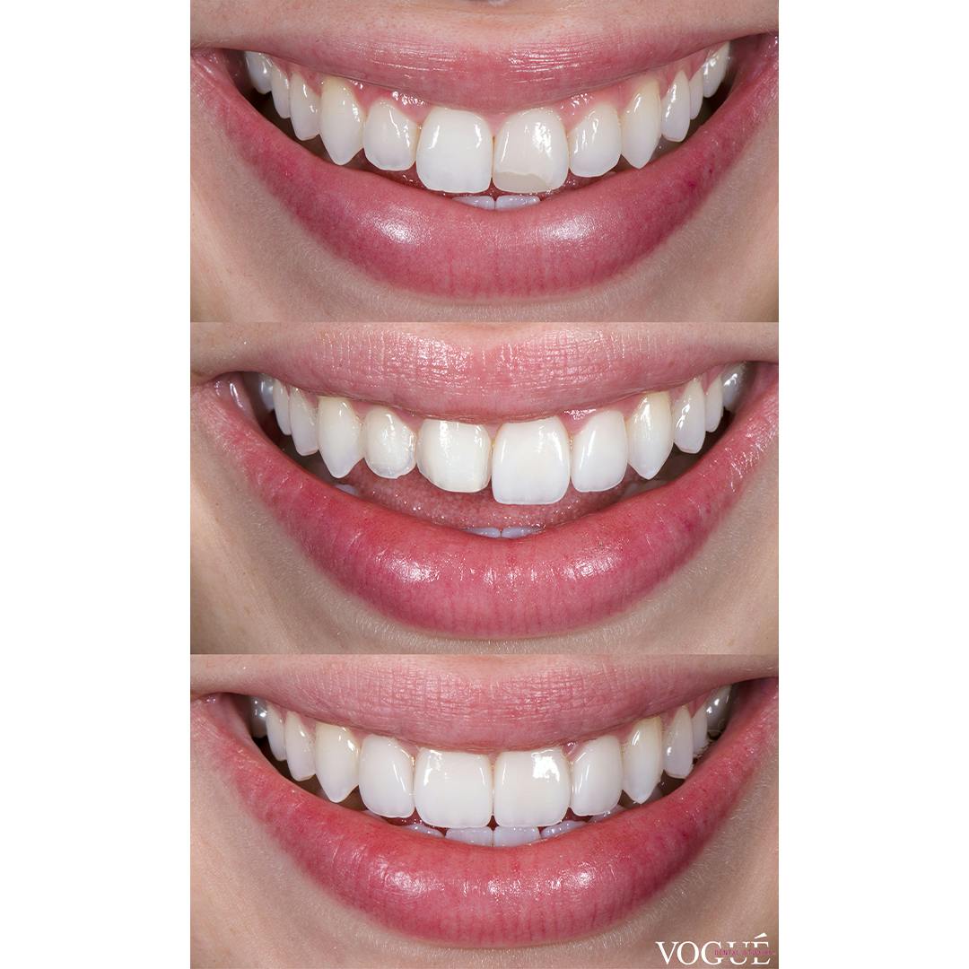 In progress comparison of porcelain veneers and the amount of teeth shaving required for specific outcomes.