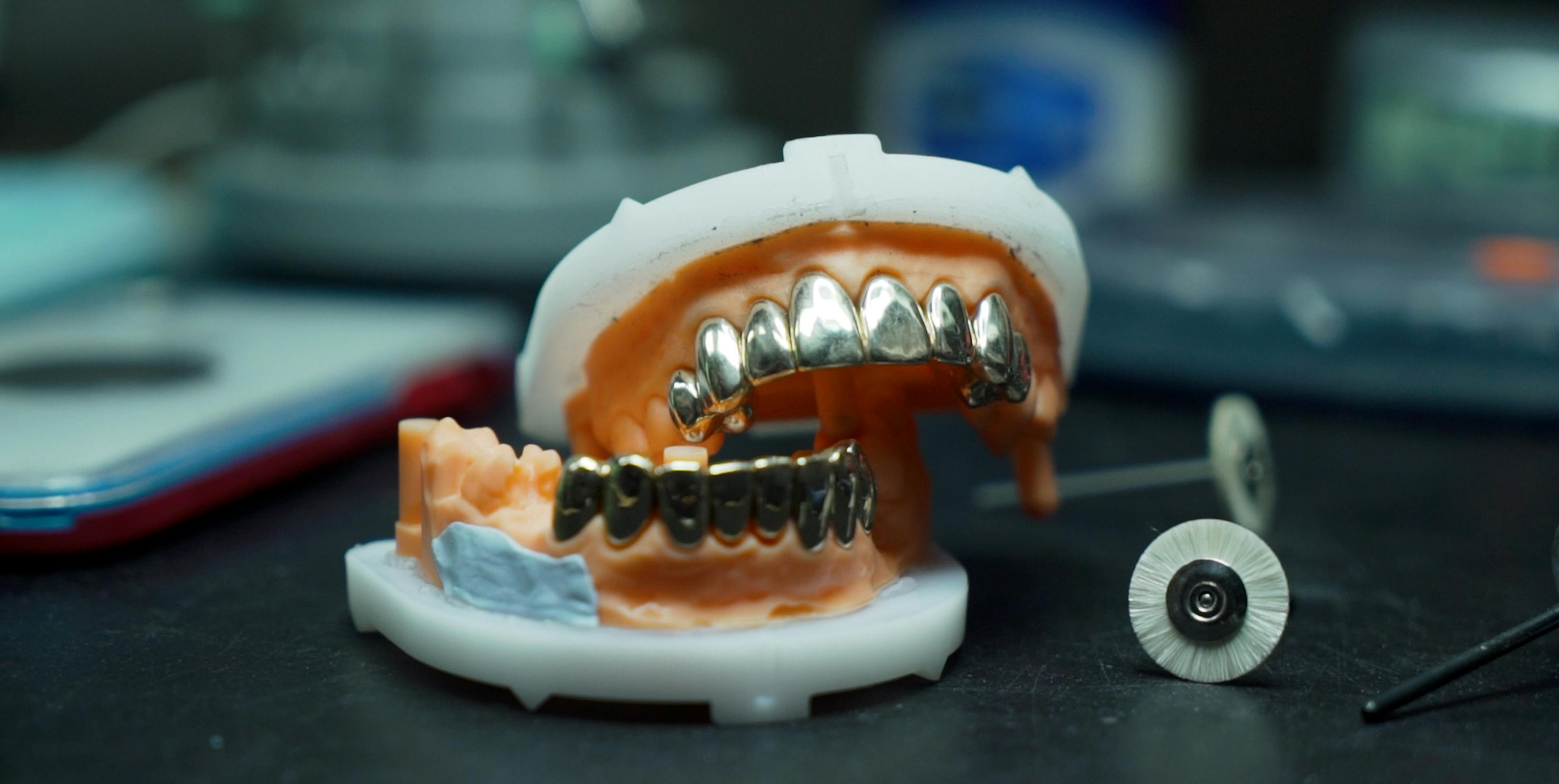 The Rise of Gold Veneers and Crowns