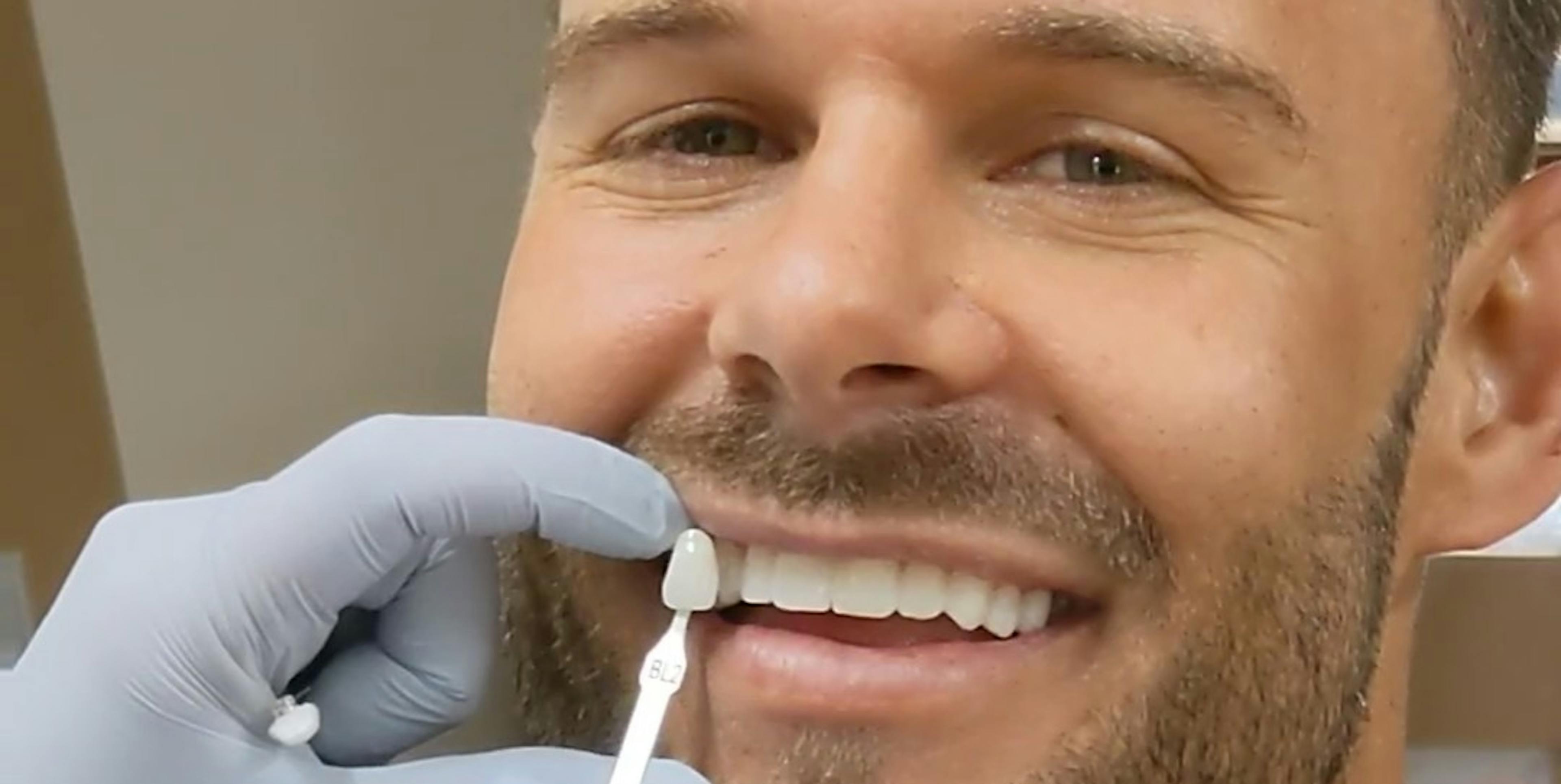 How Long Does it Take to Get Porcelain Veneers?