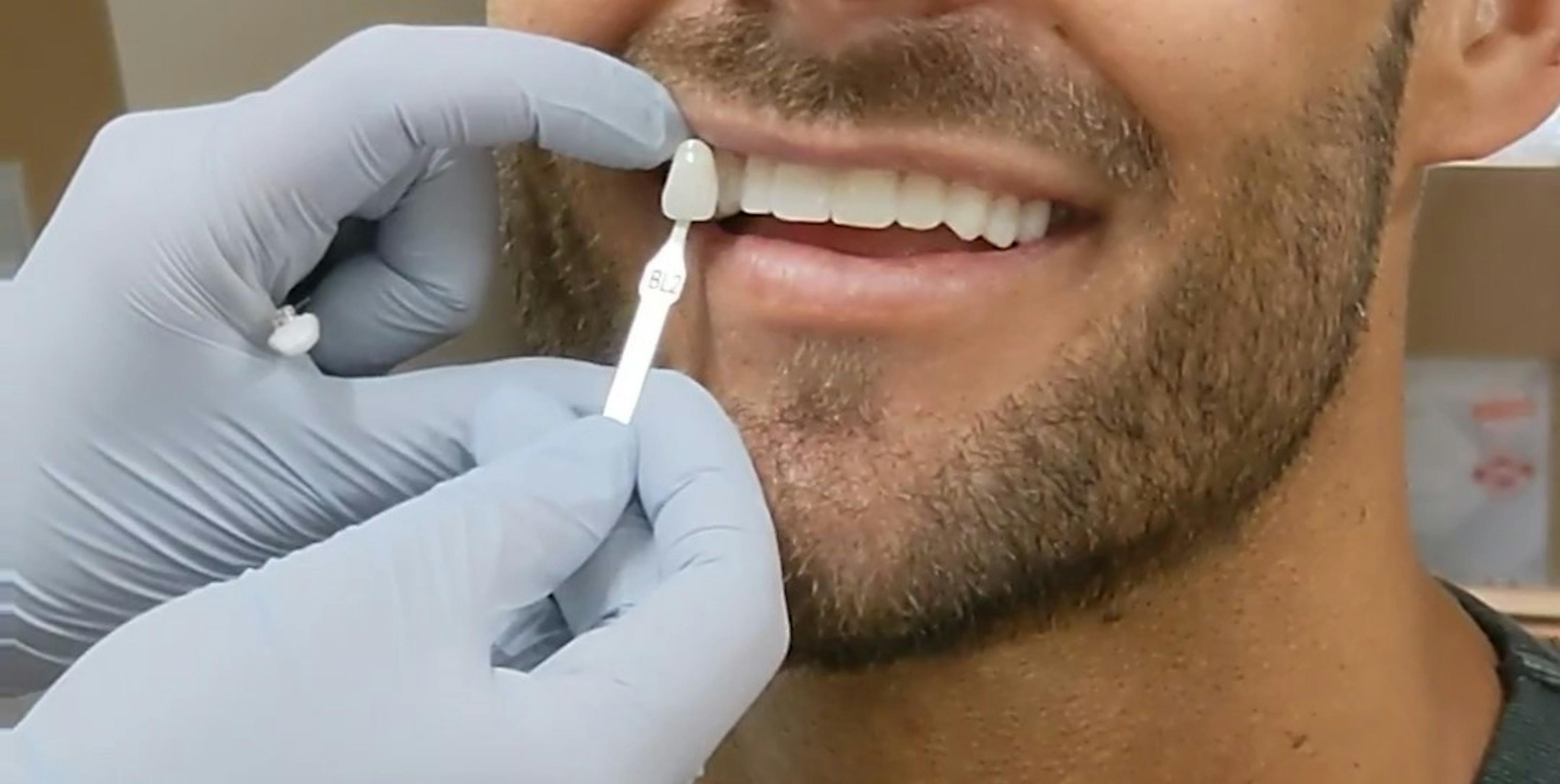 How Long Does it Take to Get Porcelain Veneers?