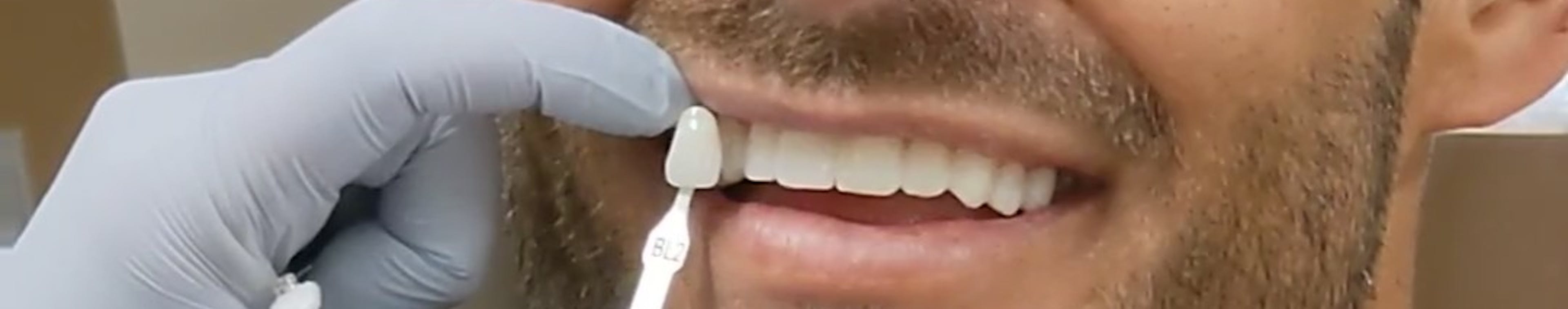 Carlin Sterrit getting veneers selection