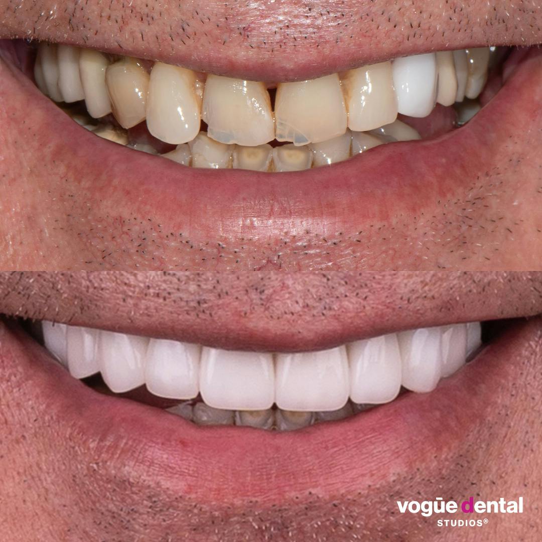 Before and after porcelain veneers and implant smile makeover at Vogue Dental Studios - front teeth view Tom