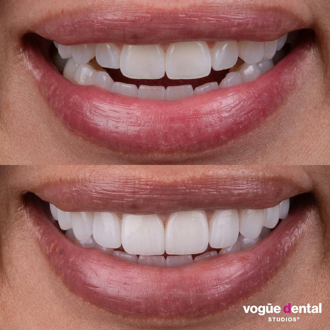 Before and after porcelain veneers at Vogue Dental Studios - front teeth view Angie.