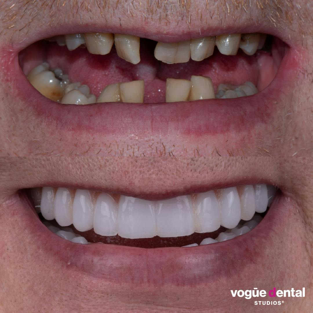 Before and after implant smile makeover at Vogue Dental Studios - front teeth view Damian