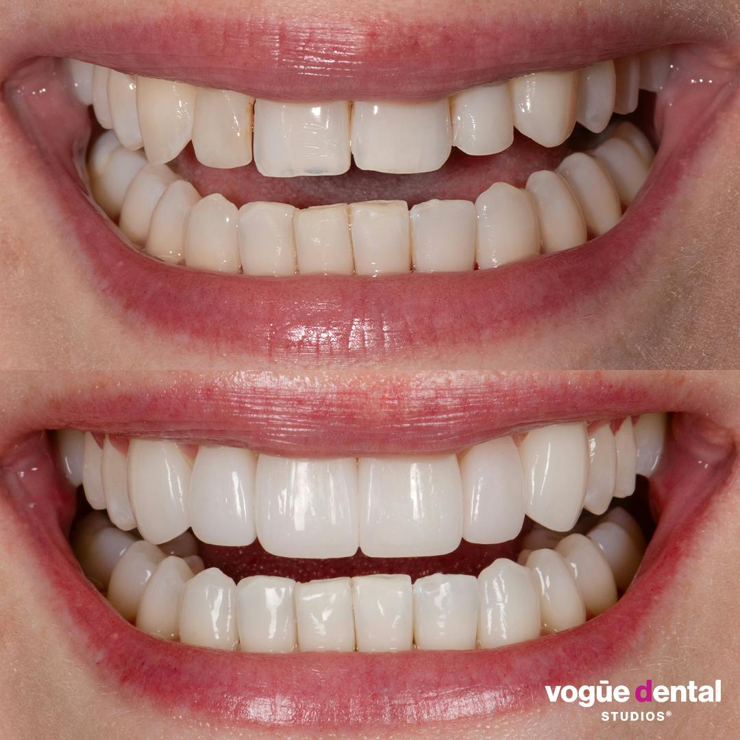 Before and after with Picasso Ultra Hybrid veneers at Vogue Dental Studios - front teeth view Eve.