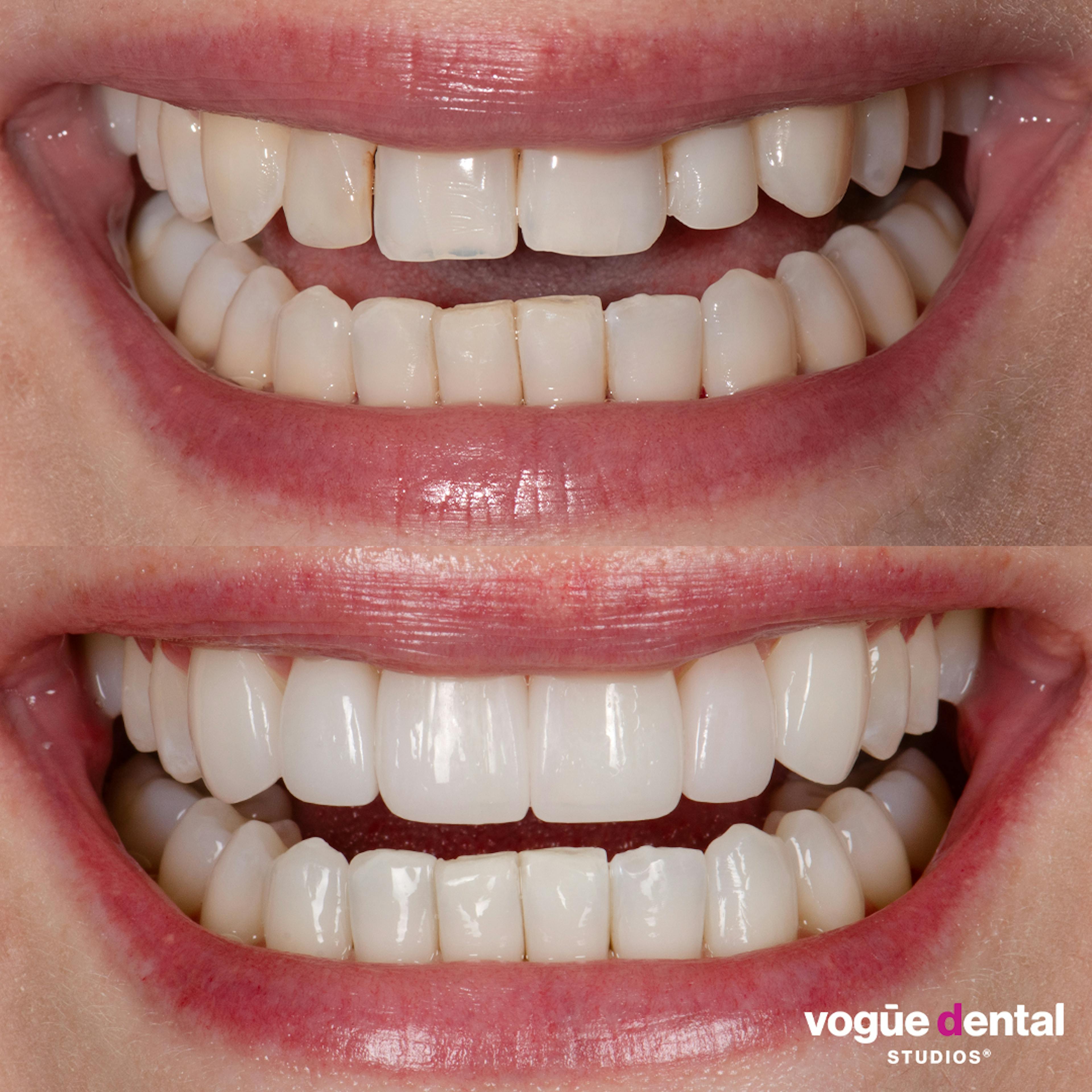 Before and after with Picasso Ultra Hybrid veneers at Vogue Dental Studios - front teeth view Eve.