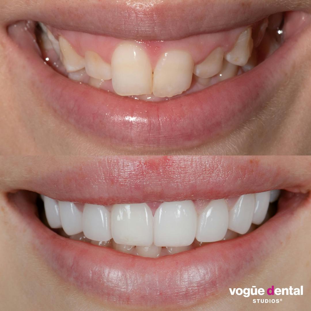 Before and after with Picasso Ultra Hybrid veneers at Vogue Dental Studios - front teeth view Lili.