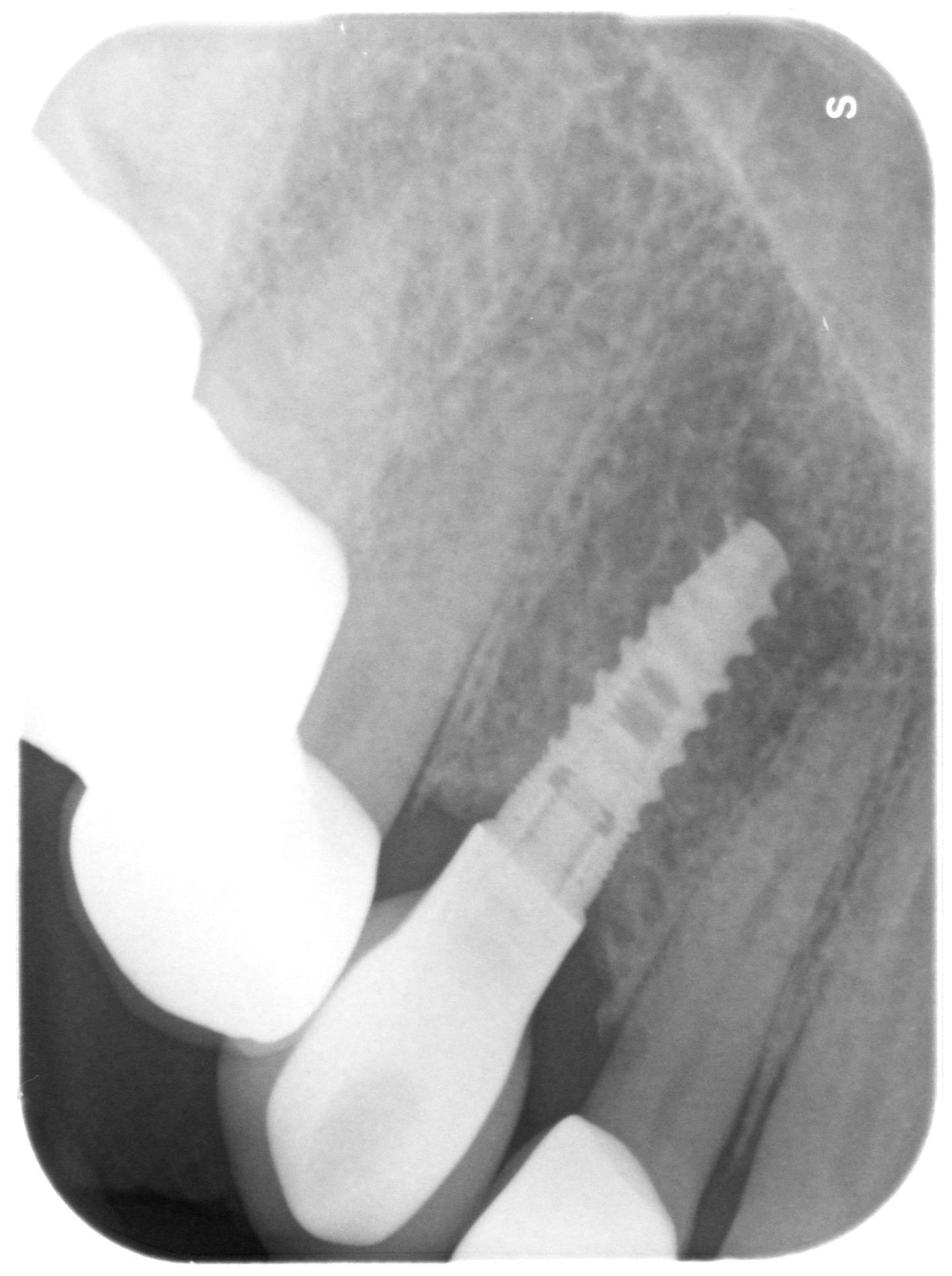 An X-ray  of a dental implant fused into the jawbone