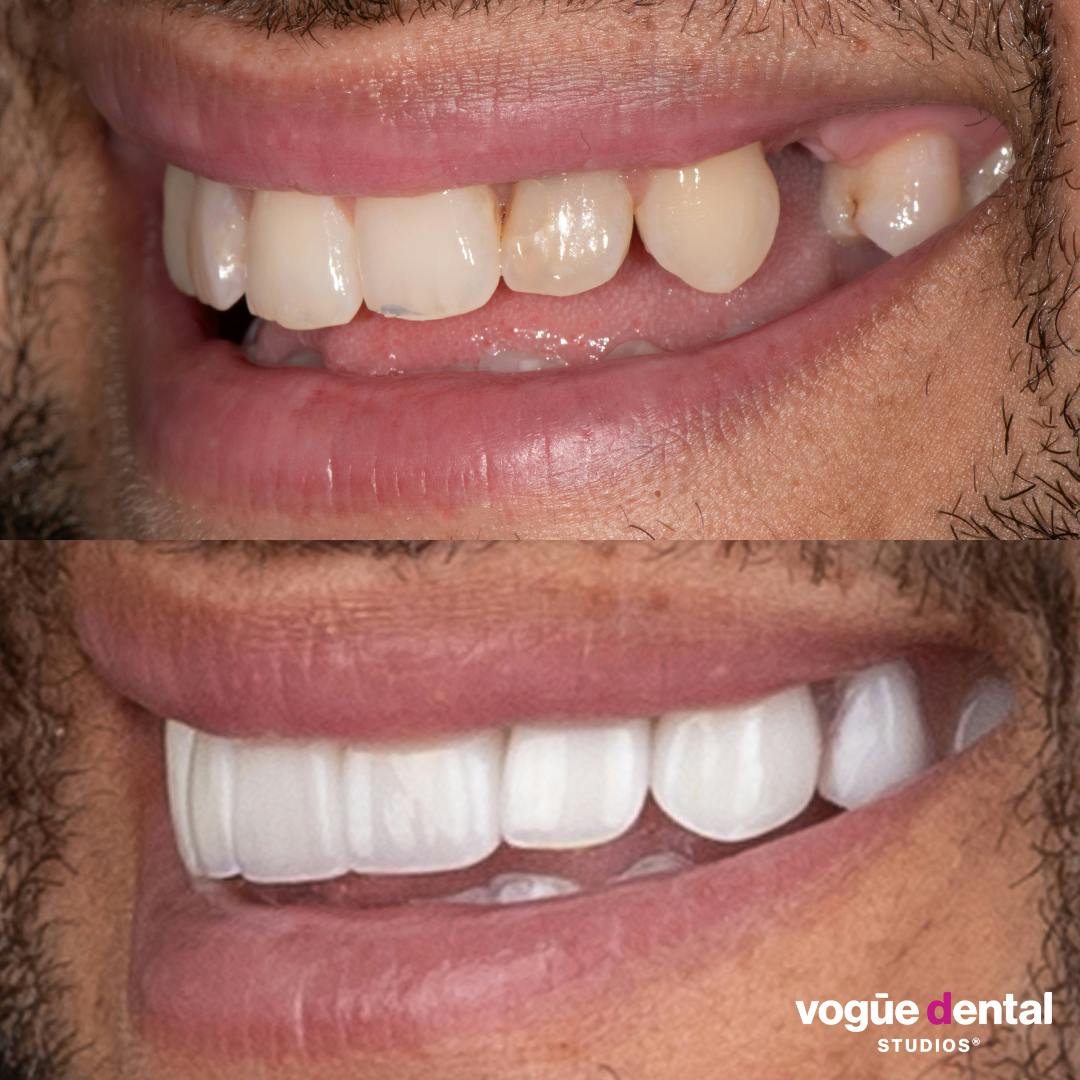 Before and after implants smile left view