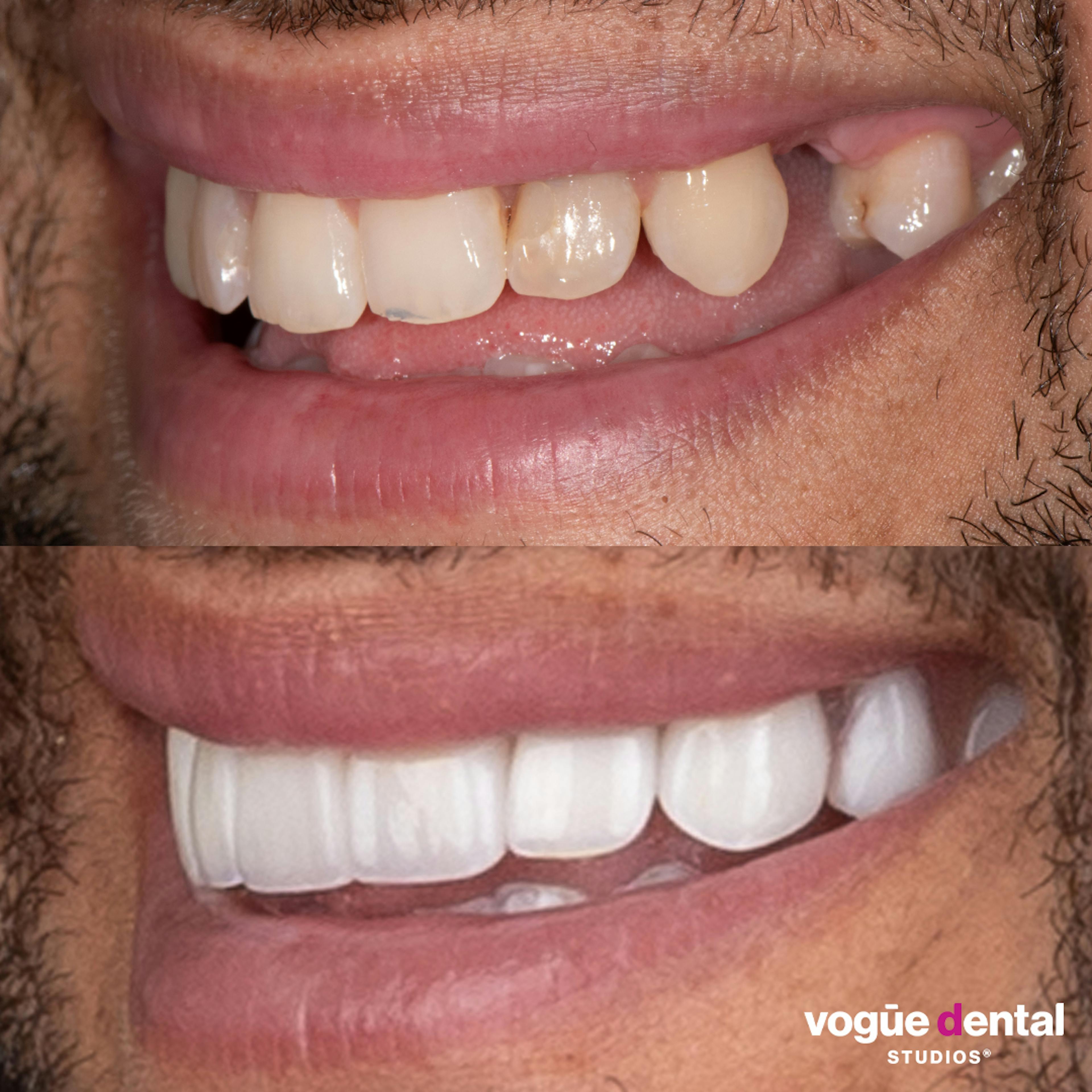 Before and after implants smile left view