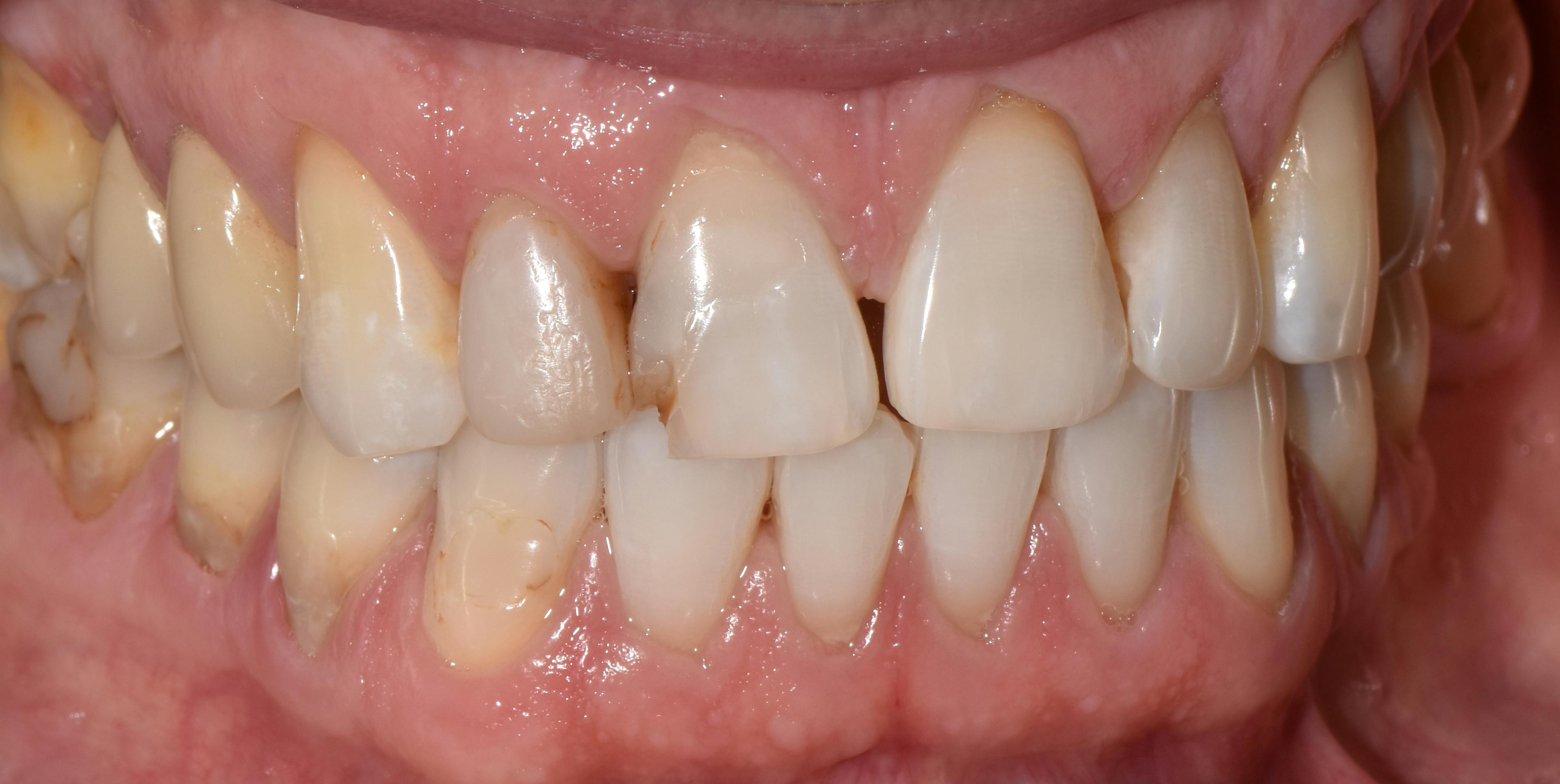 What are Abfraction and Abfraction Lesions and what is the link with Bruxism?