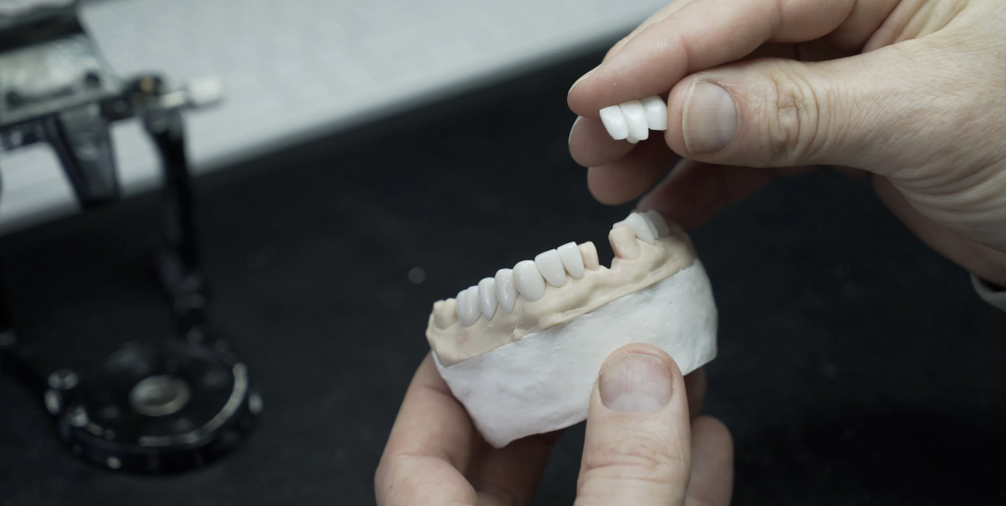 Dental Crowns vs Dental Veneers: What’s the difference?