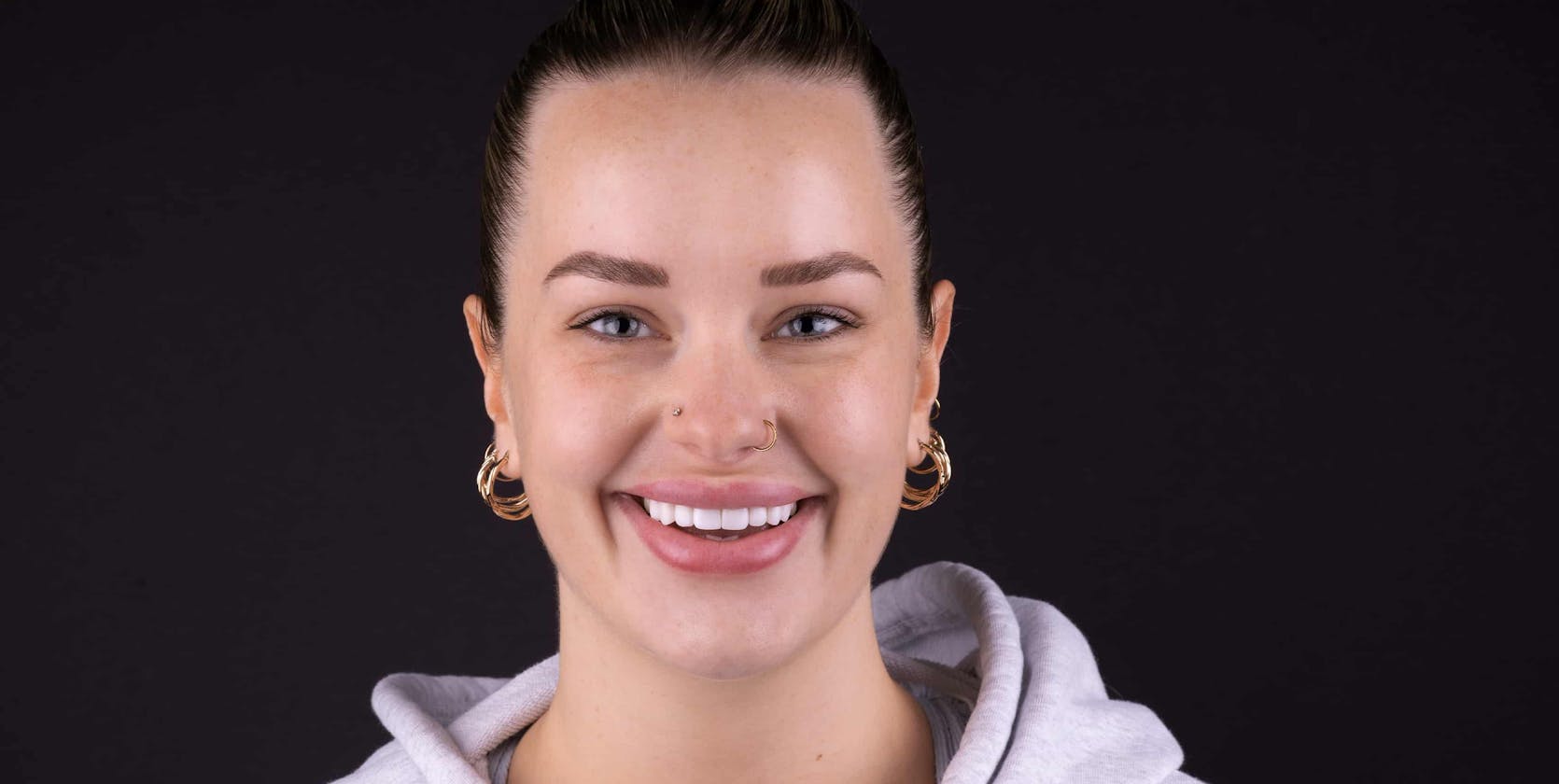 Smile makeover with wisdom teeth removal