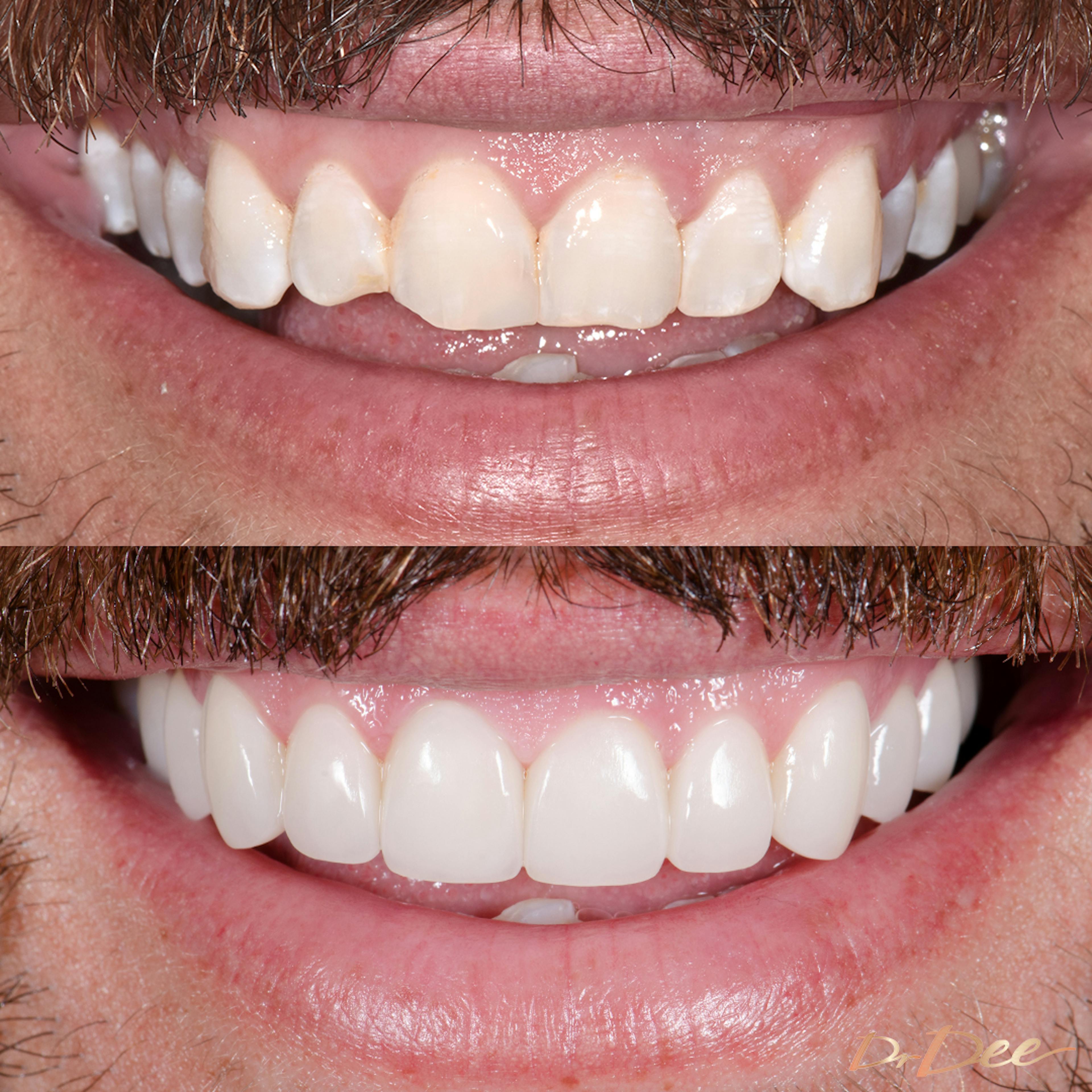 Sandor Earl's smile before and after porcelain veneers with minimal teeth filing/shaving.
