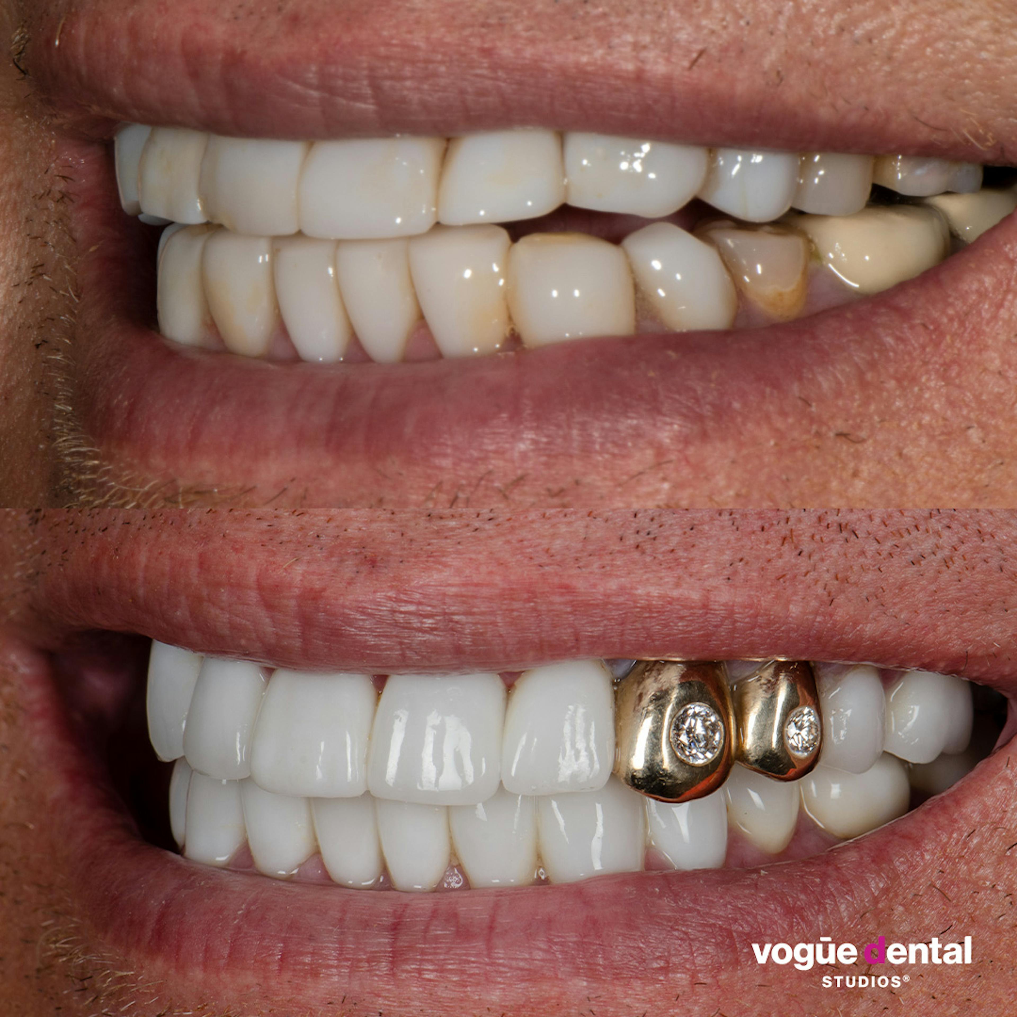 Gold crown with gem designed by Dr Dee