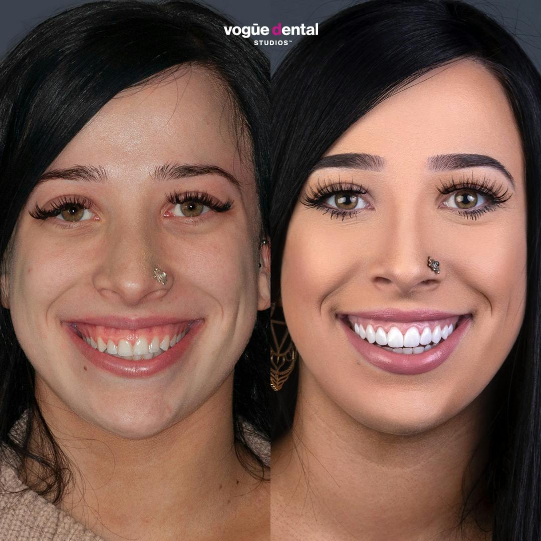 Before and after gum lift procedure for a complete smile makeover to address a gummy smile