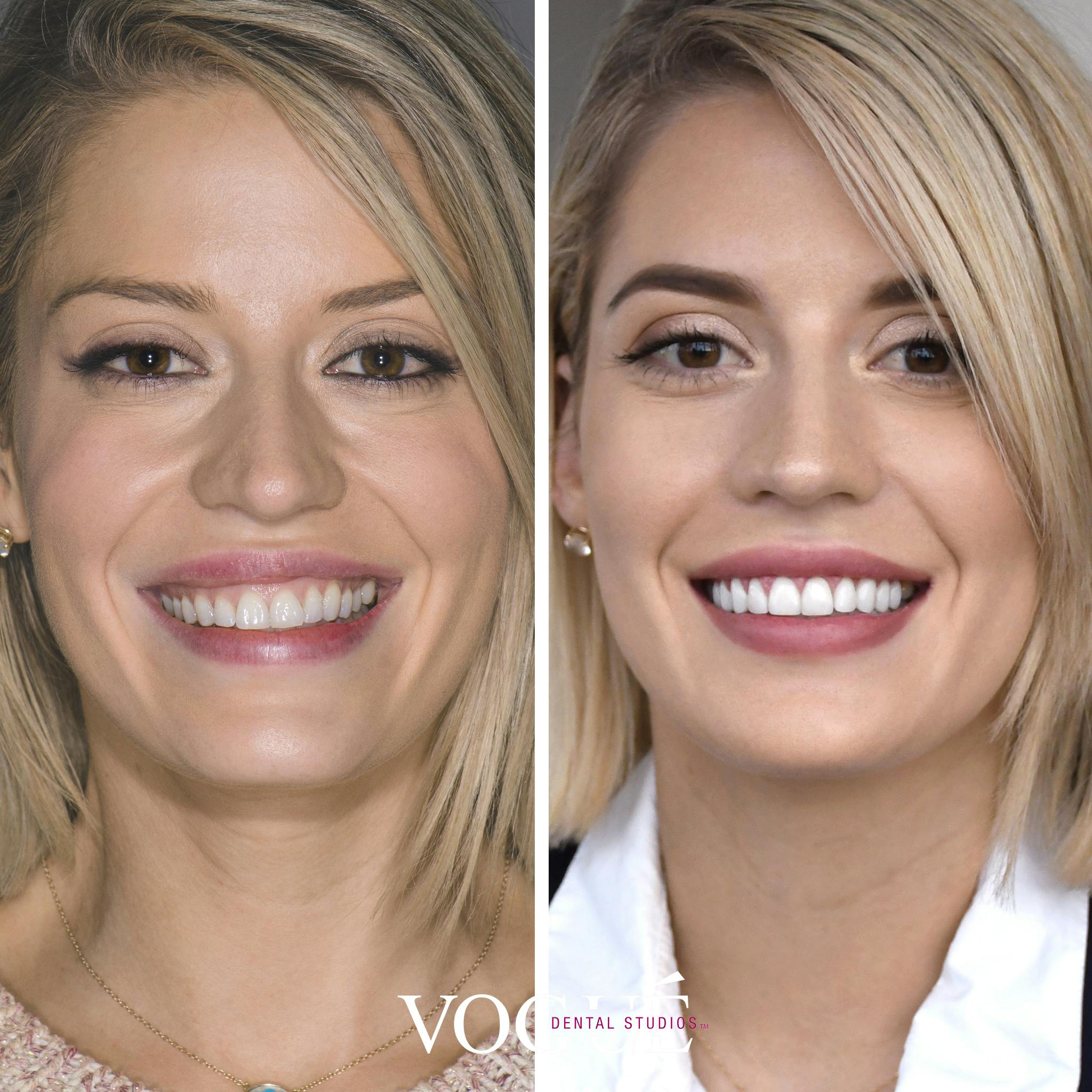 Before and after a canted smile or skewed smile treated with porcelain veneers and gum laser surgery.