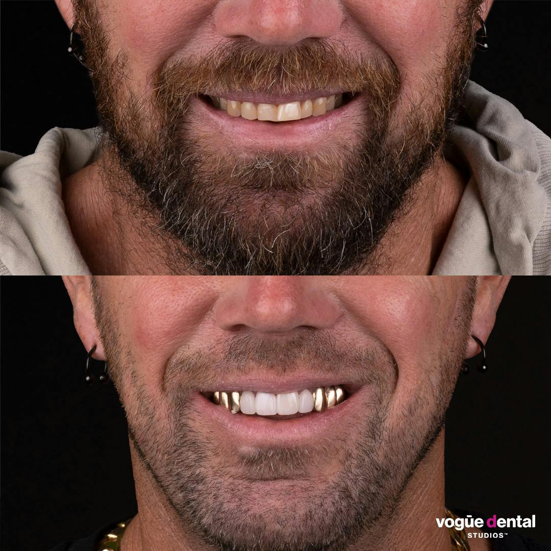 Gold veneers in a smile makeover by Dr Dee at Vogue Dental Studios
