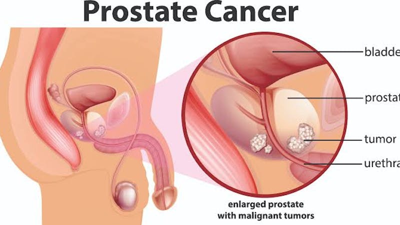 Here are important things to know about prostate cancer - a type of cancer that affects the prostate. The prostate is a small walnut-shaped gland in men that produces the seminal fluid that nourishes and transports sperm cells.