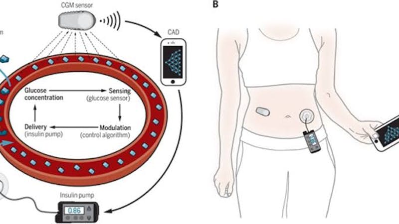Advances in artificial pancreas system: New study finds that artificial pancreas helps children with type 1 diabetes control their blood glucose levels
