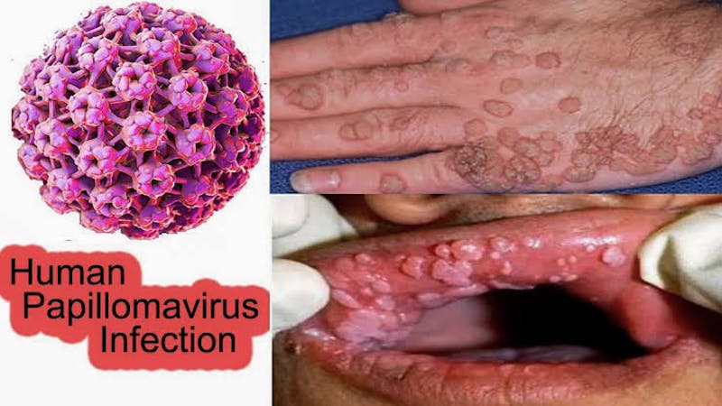 Human papillomavirus in sentence Cancer laringian speranta de viata