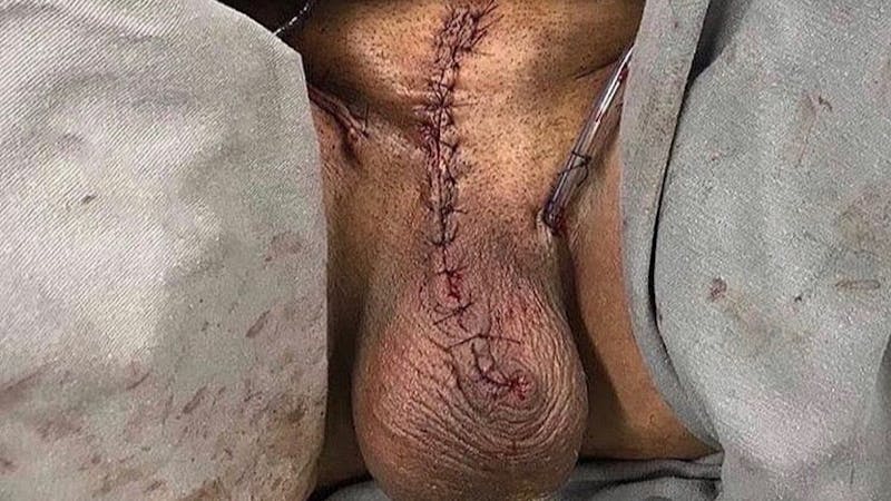 Can there be sexual desire after penectomy? - Clacified Can there be sexual desire after penectomy? - Clacified