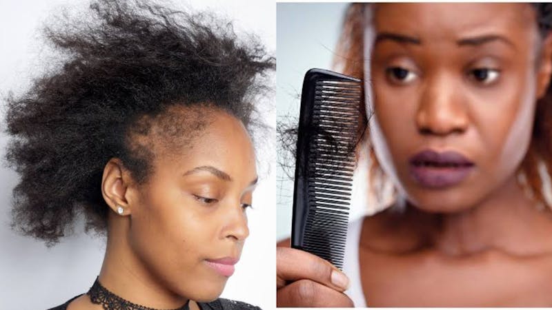 Women experiencing early hair loss