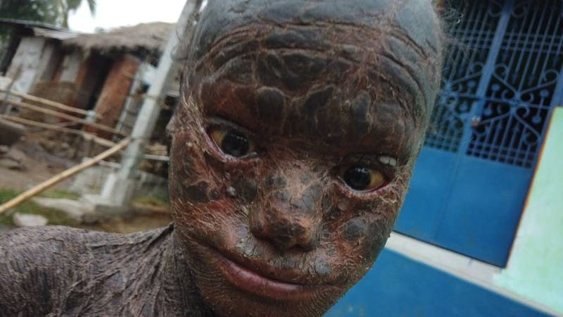 Jagannath, an Indian boy dubbed, "snake skin" because he has the rare skin condition called lamellar ichthyosis