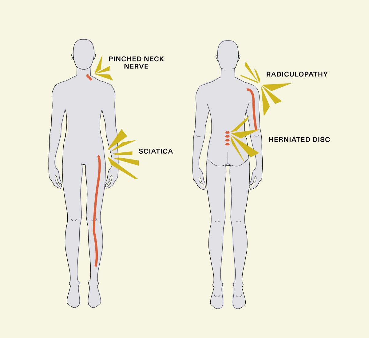 What is a Pinched Nerve? [Common Causes & Treatments]