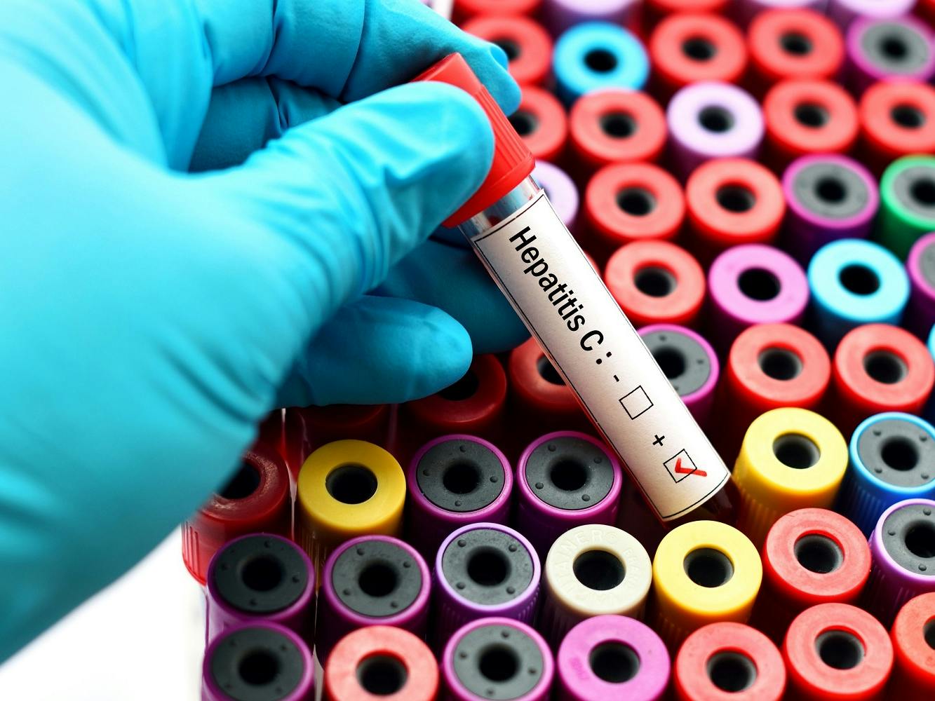 Does Medicare Cover Hep C Testing?