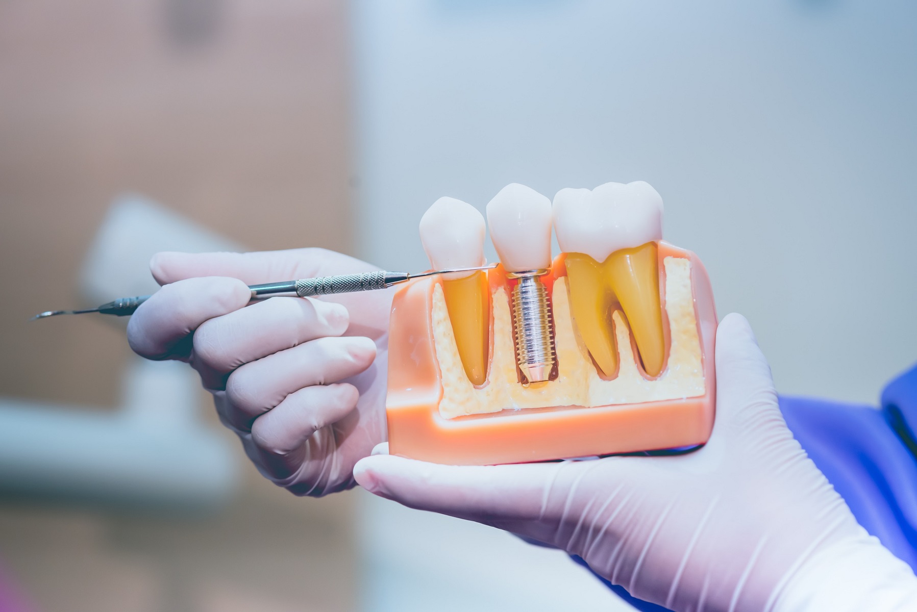 Are Dental Implants Covered Under Medicaid? | ClearMatch Medicare