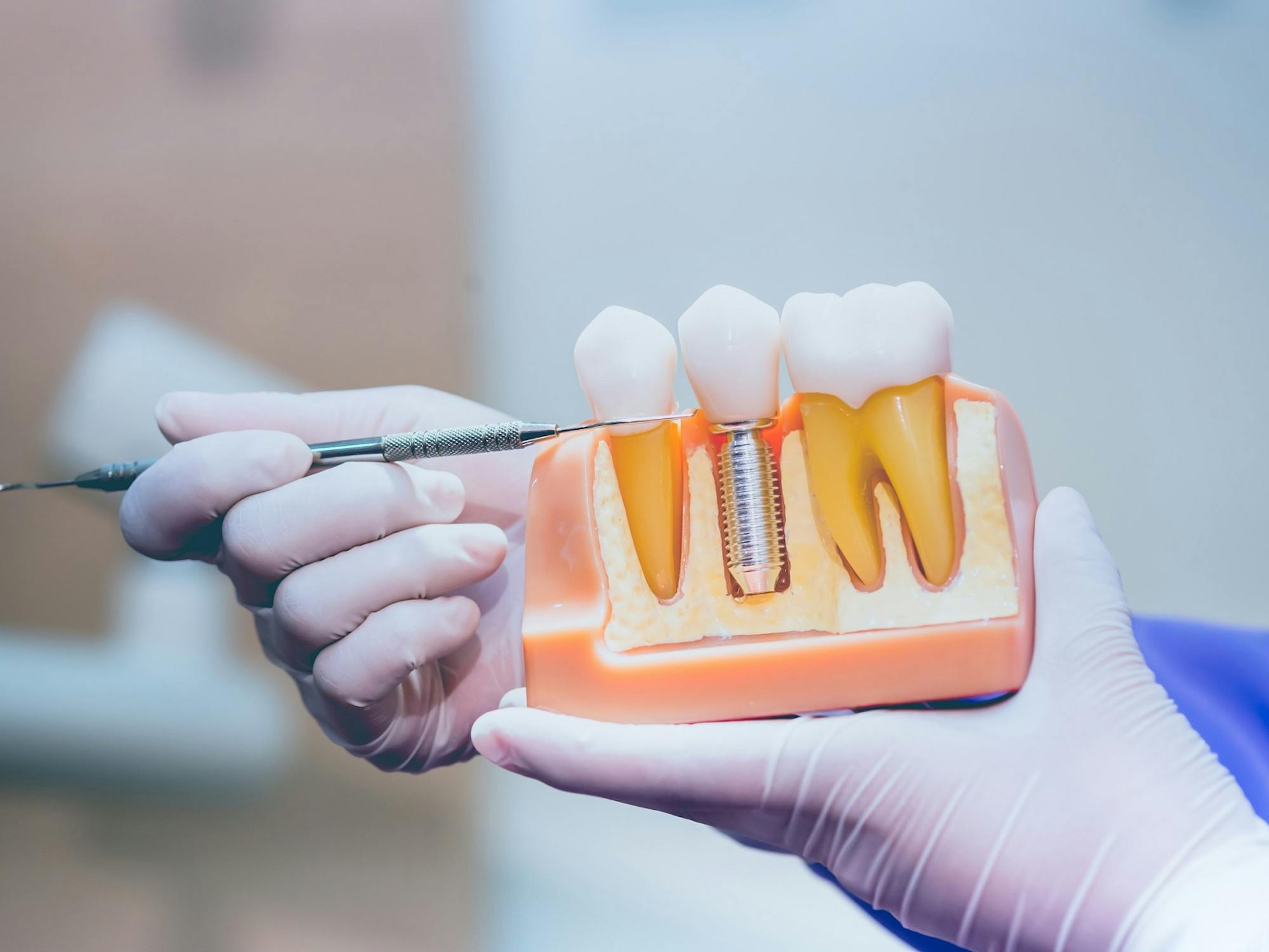 Are Dental Implants Covered Under Medicaid? ClearMatch Medicare