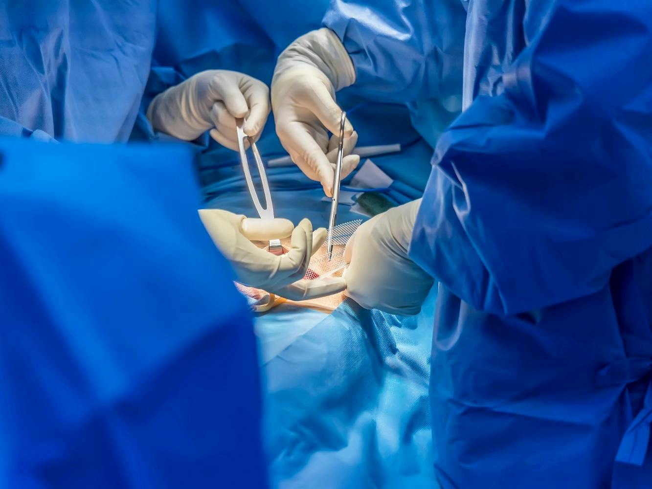 Does Medicare Cover Hernia Surgery?