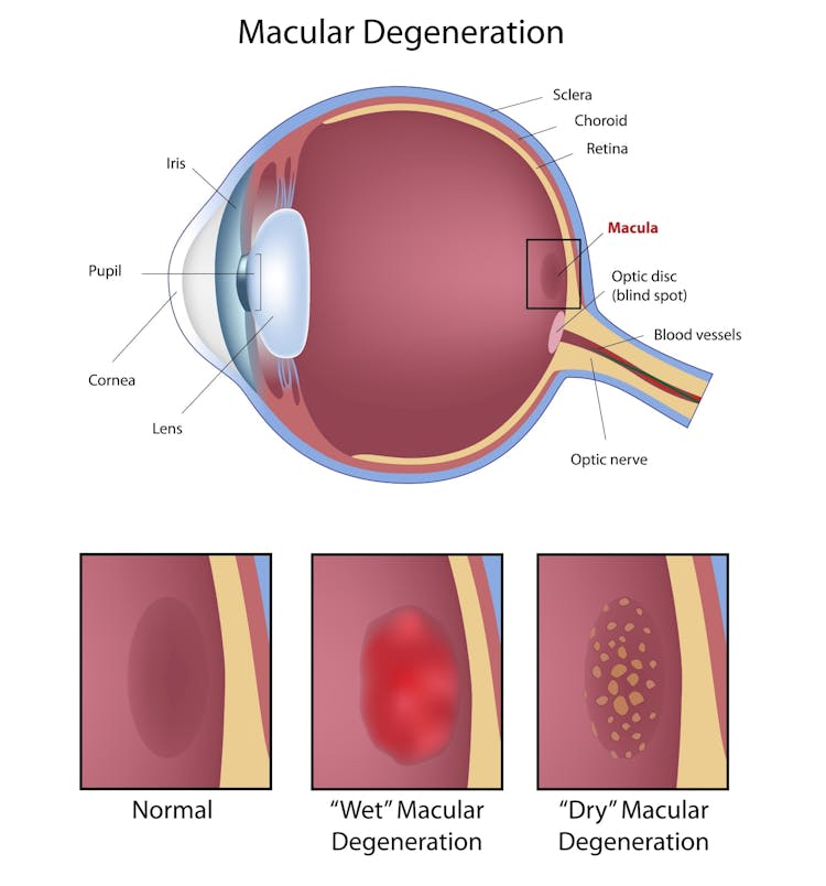 What Is Macular Degeneration And How Can You Prevent It? ClearMatch