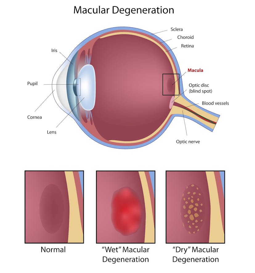 What Is Macular Degeneration And How Can You Prevent It? ClearMatch