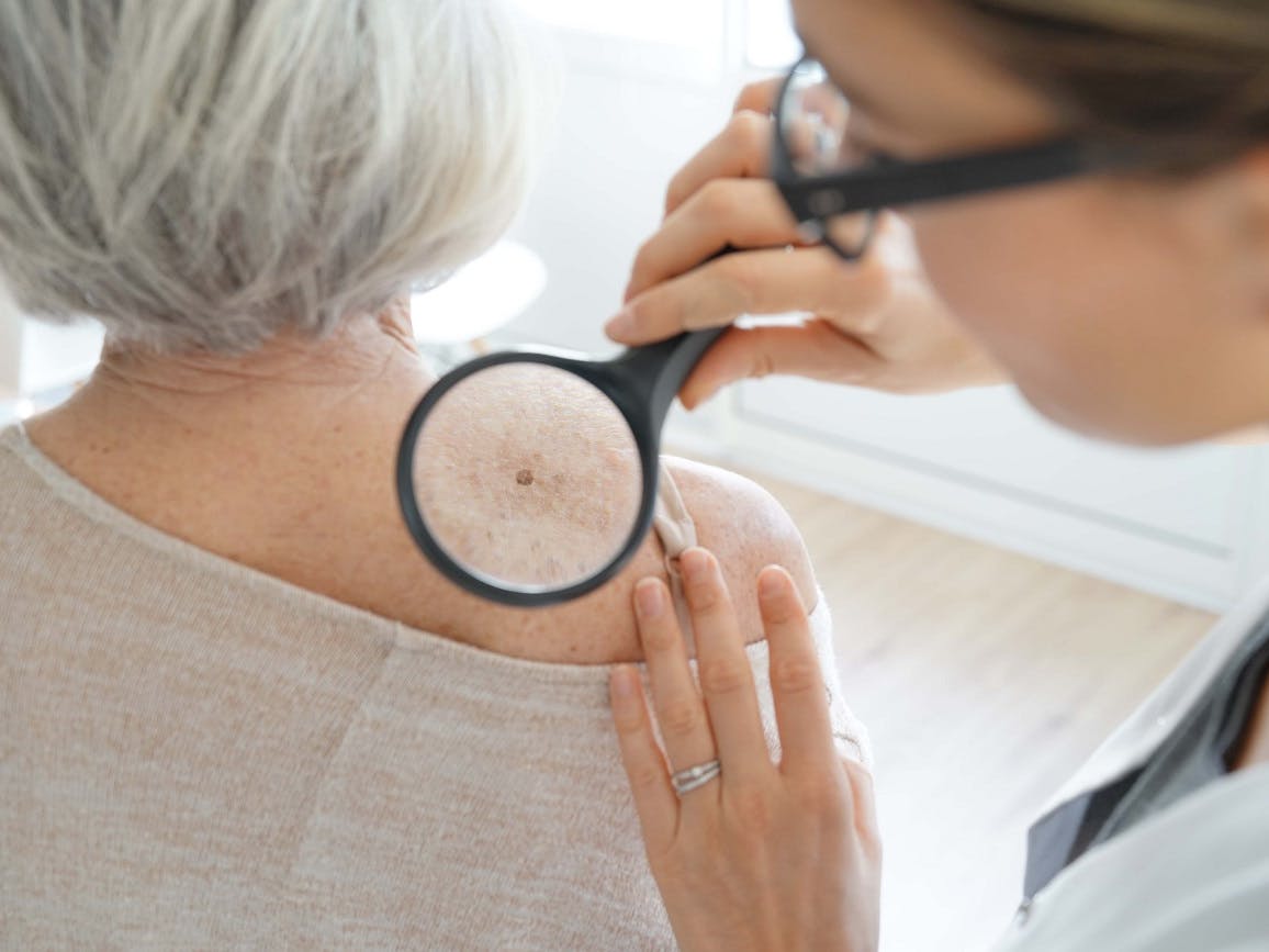 Does Medicare Cover Skin Tag Removal?