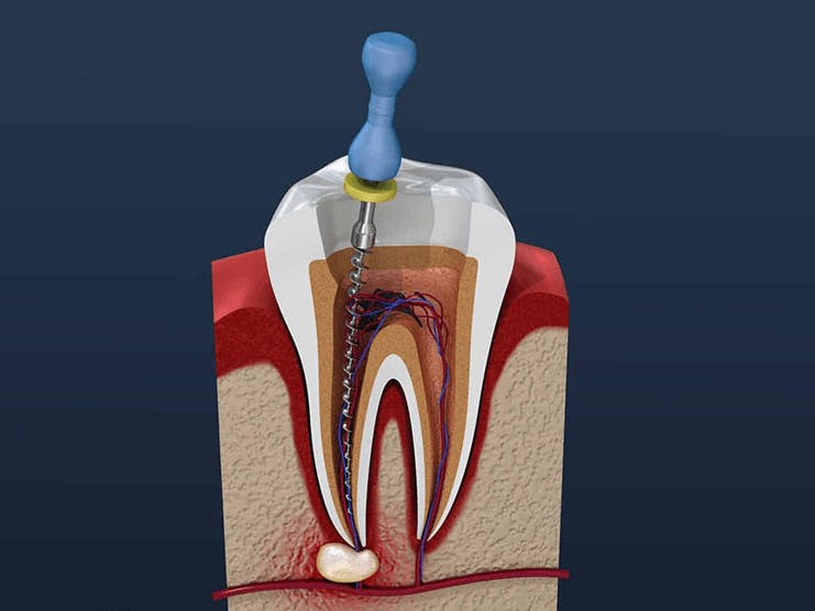 Does Medicaid Cover Root Canals