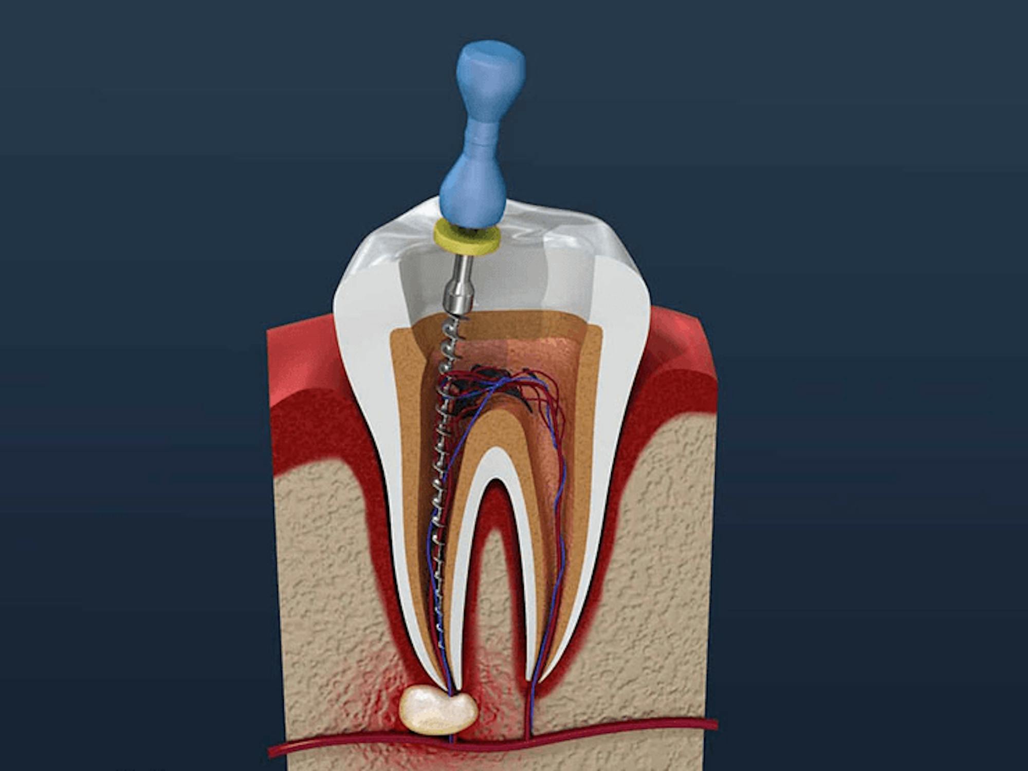 Does Medicaid Cover Root Canals ClearMatch Medicare Does Medicaid Cover Root Canals ClearMatch Medicare