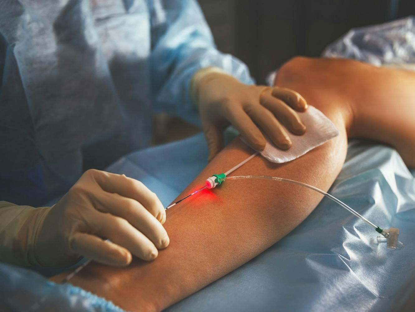 Does Medicare Cover Varicose Vein Treatment